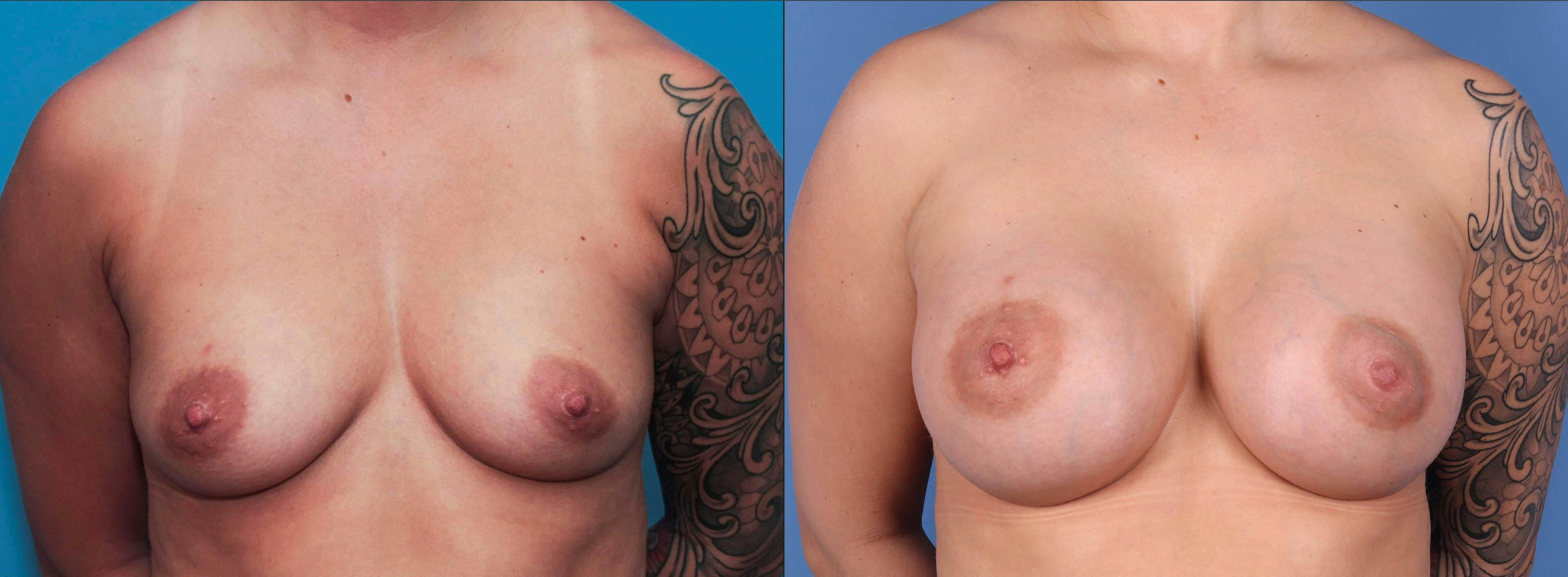 Breast Augmentation Before & After Gallery - Patient 89190411 - Image 1