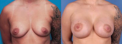 Breast Augmentation Before & After Gallery - Patient 89190411 - Image 1