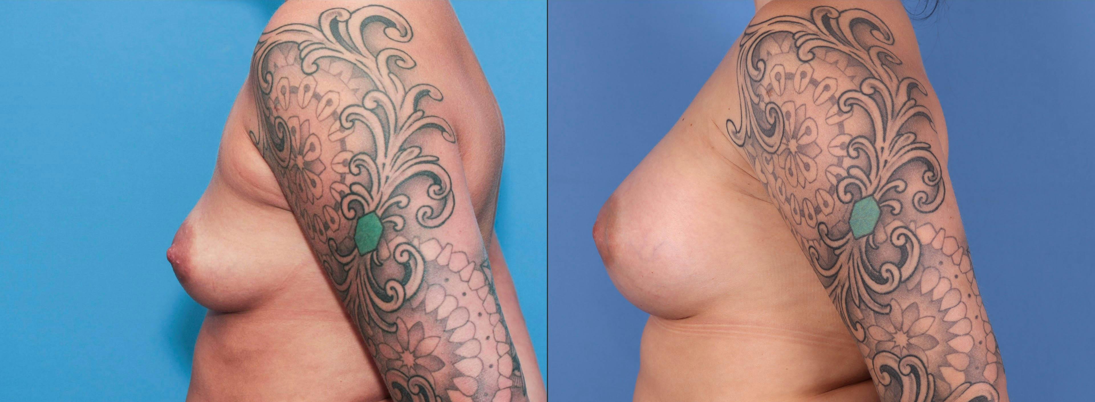 Breast Augmentation Before & After Gallery - Patient 89190411 - Image 2