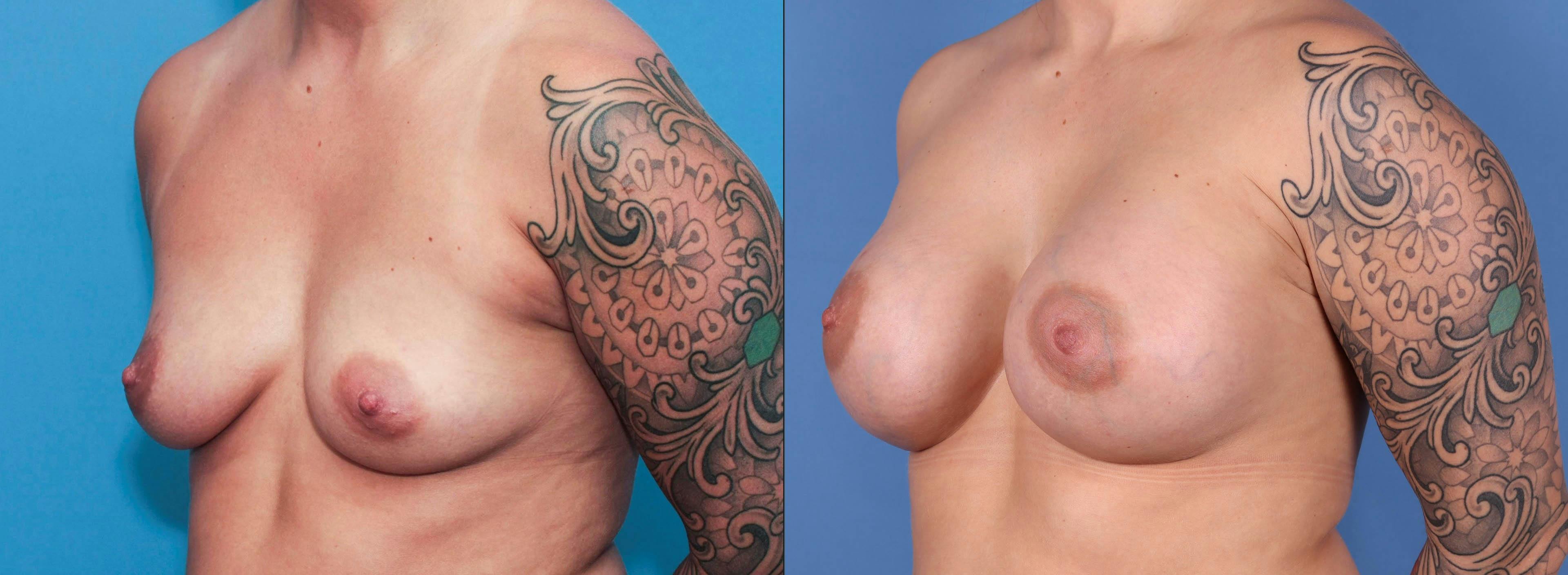 Breast Augmentation Before & After Gallery - Patient 89190411 - Image 3