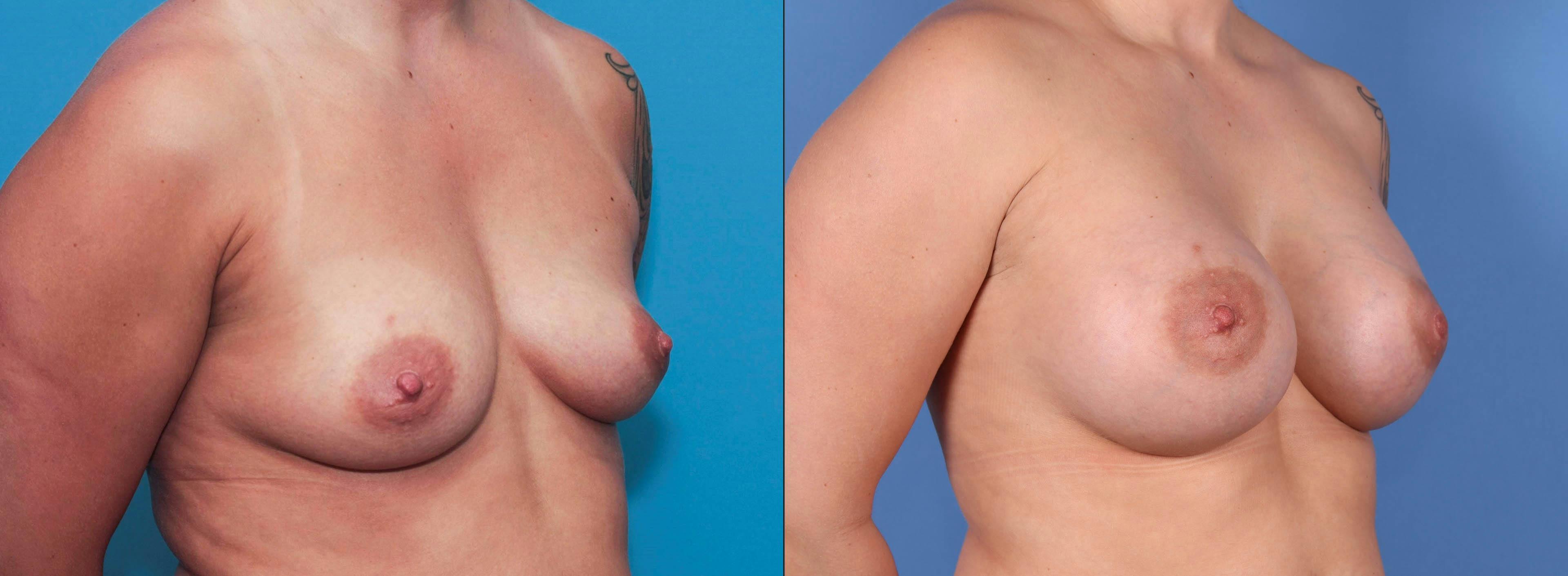 Breast Augmentation Before & After Gallery - Patient 89190411 - Image 5