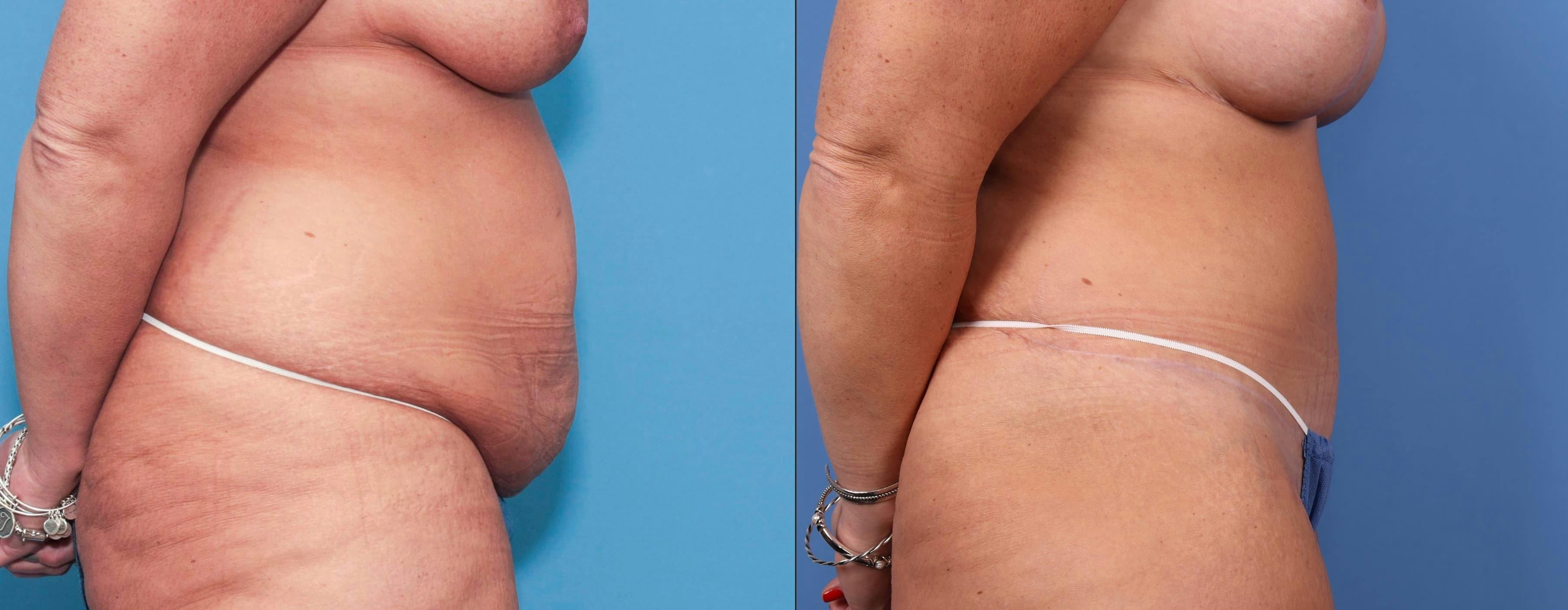 Tummy Tuck Before & After Gallery - Patient 90354609 - Image 2