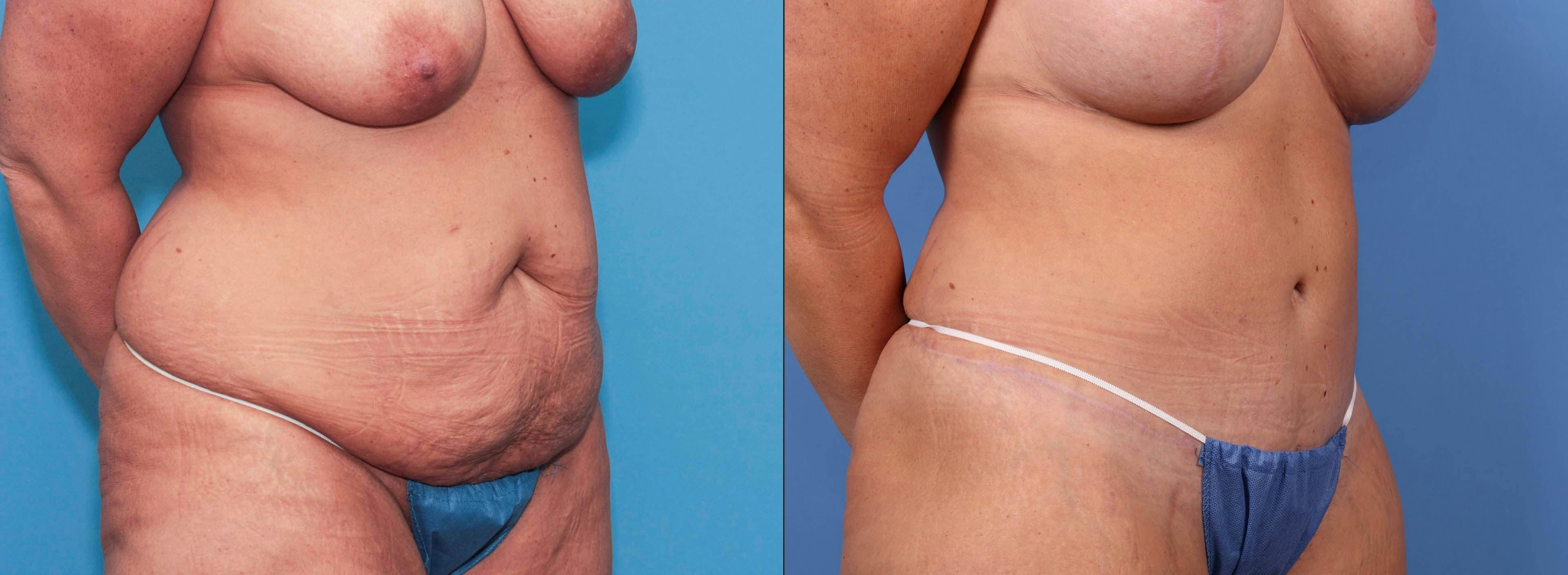 Tummy Tuck Before & After Gallery - Patient 90354609 - Image 3