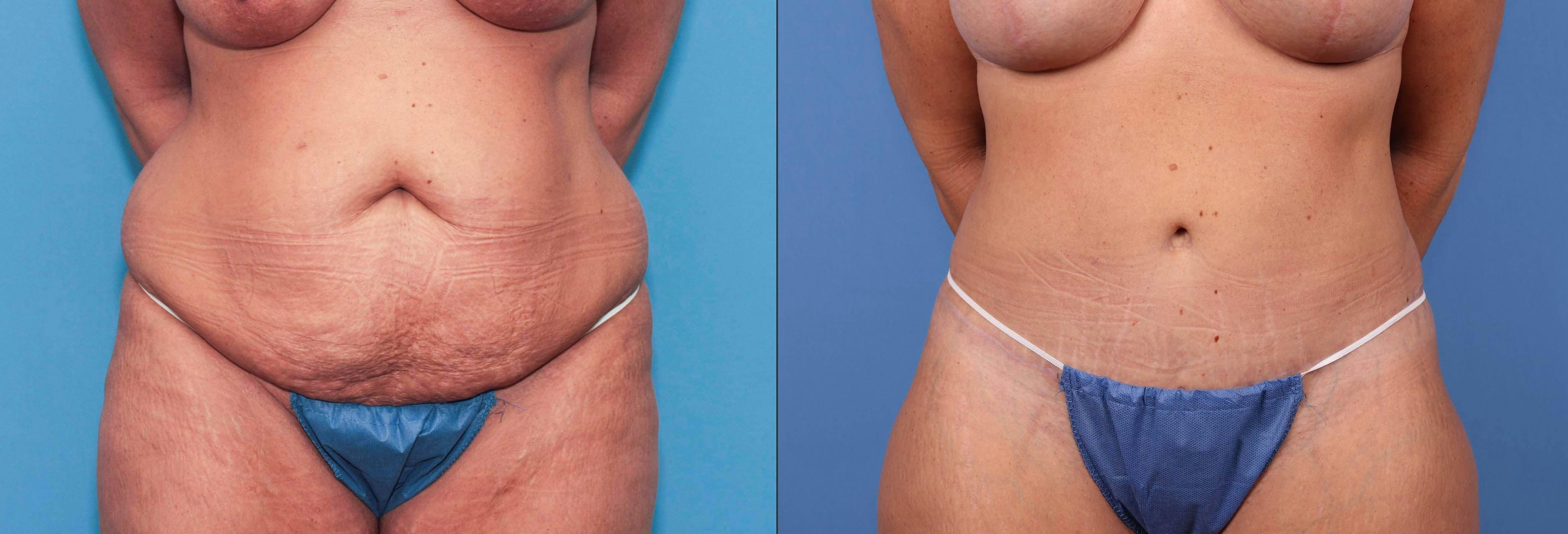 Tummy Tuck Gallery - Patient 90354609 - Image 1