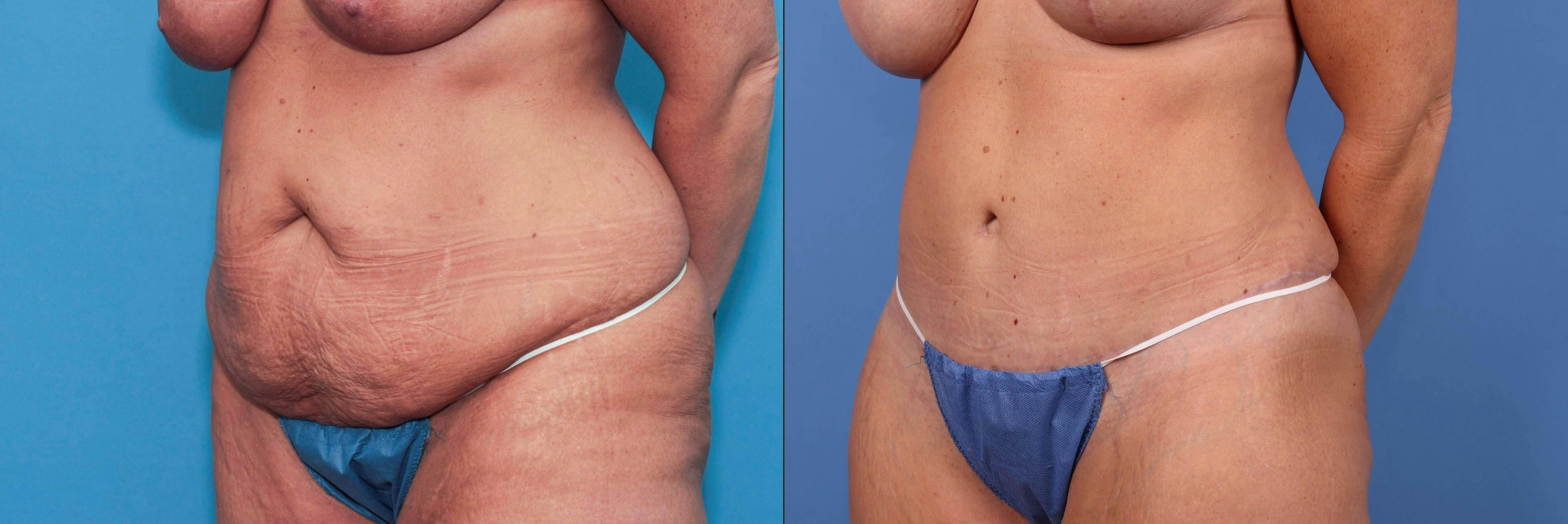 Mommy Makeover Before & After Gallery - Patient 90354572 - Image 5