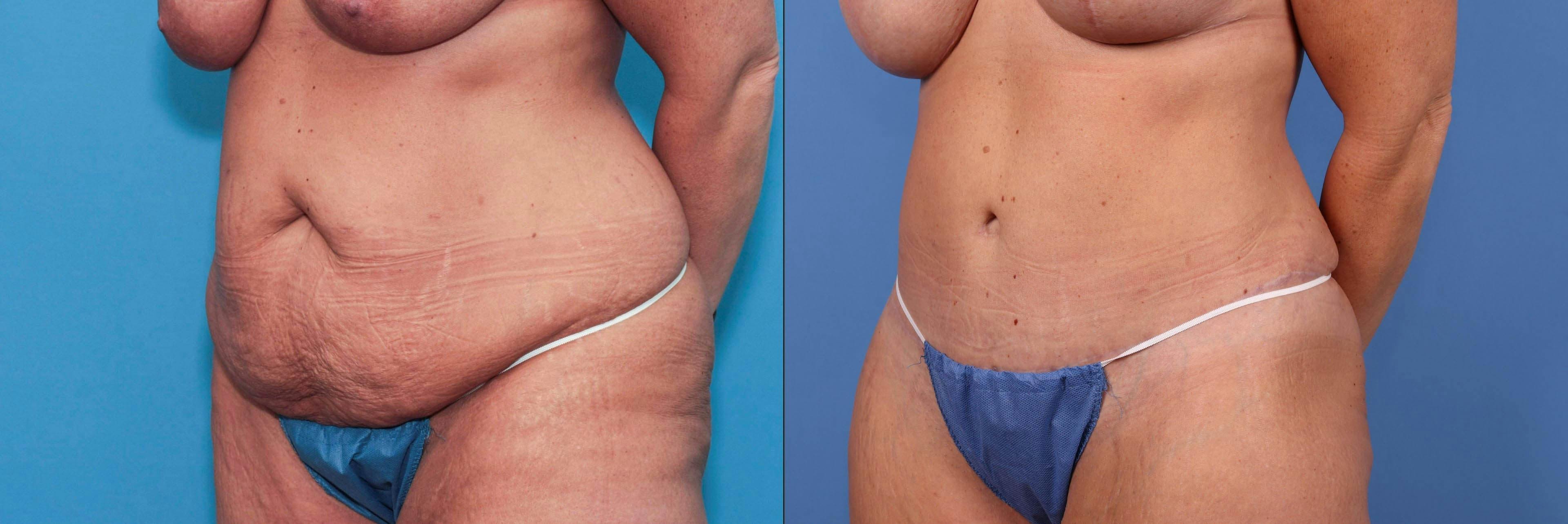 Tummy Tuck Before & After Gallery - Patient 90354609 - Image 4