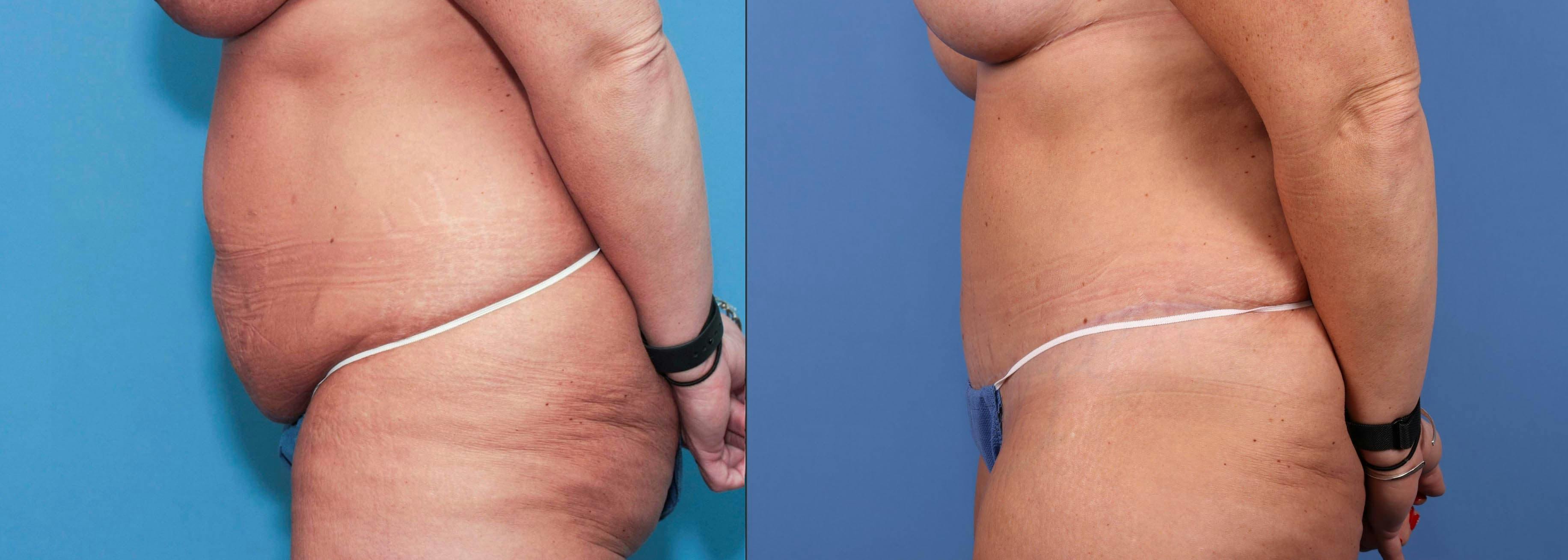 Tummy Tuck Before & After Gallery - Patient 90354609 - Image 5