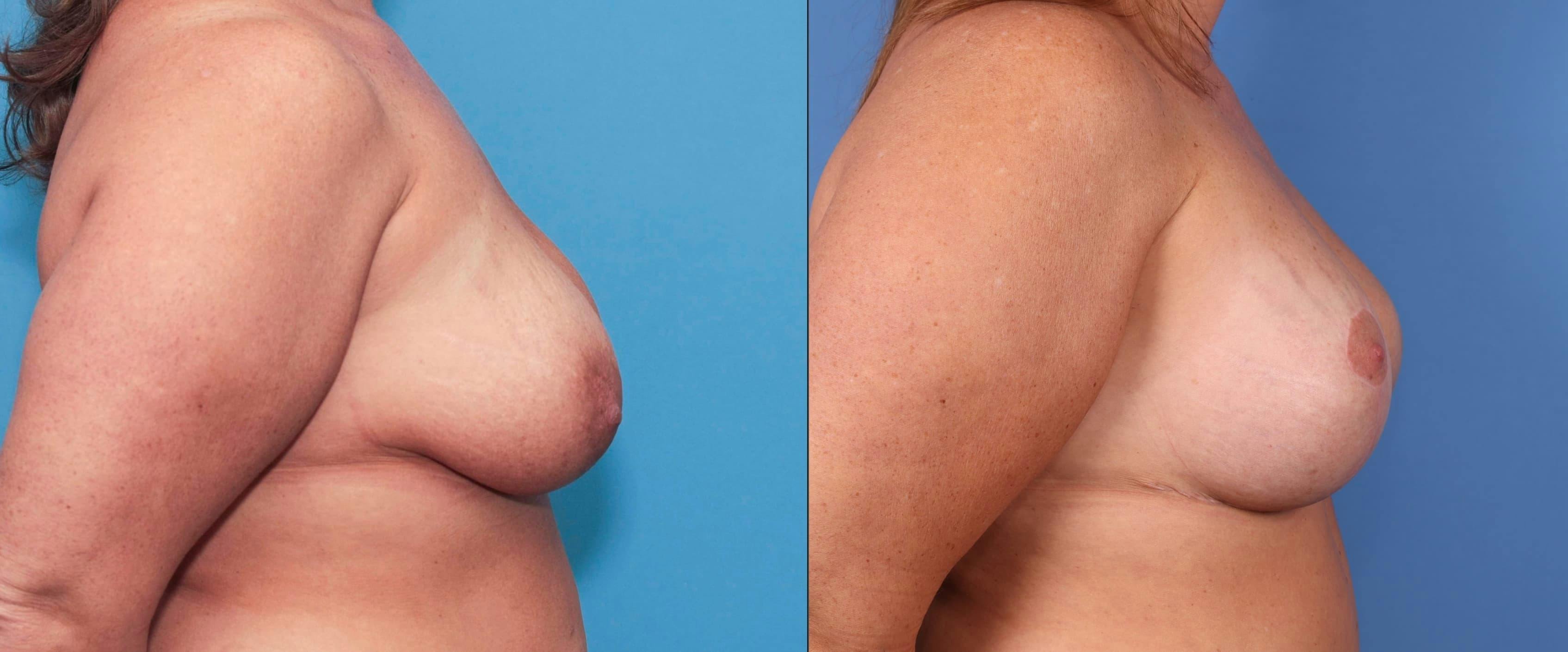Breast Lift Before & After Gallery - Patient 90354636 - Image 2