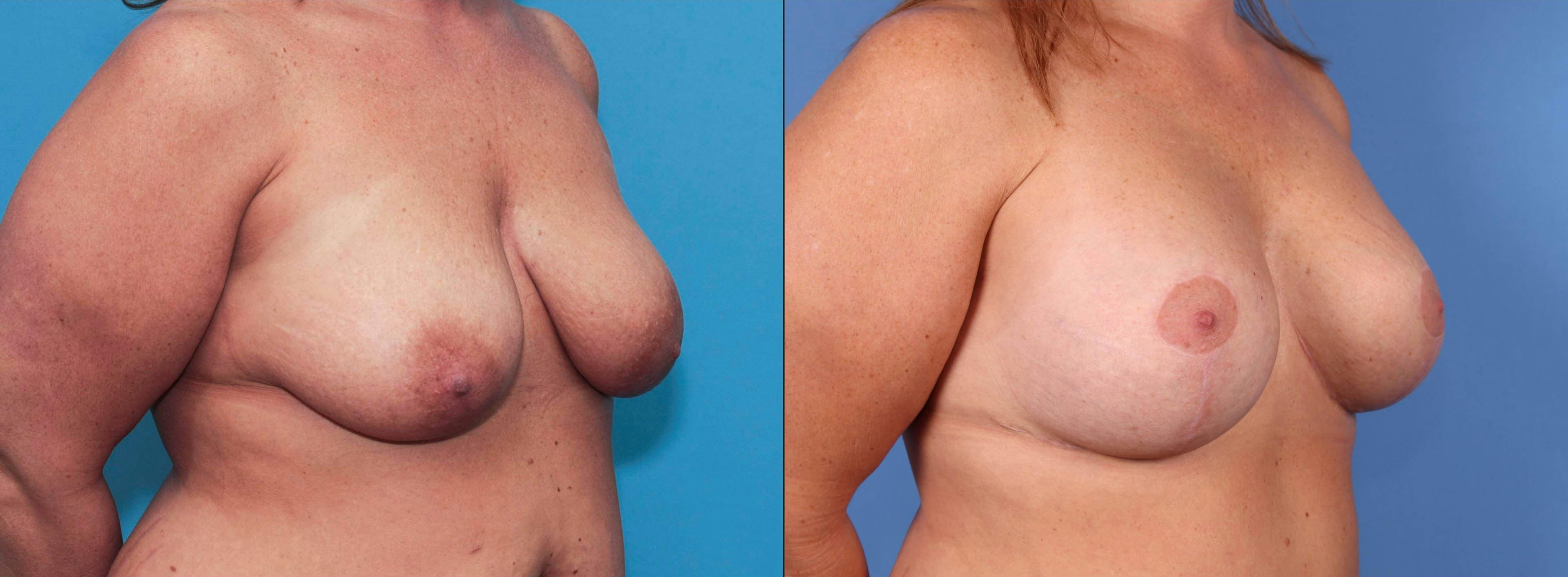 Breast Lift Gallery - Patient 90354636 - Image 3