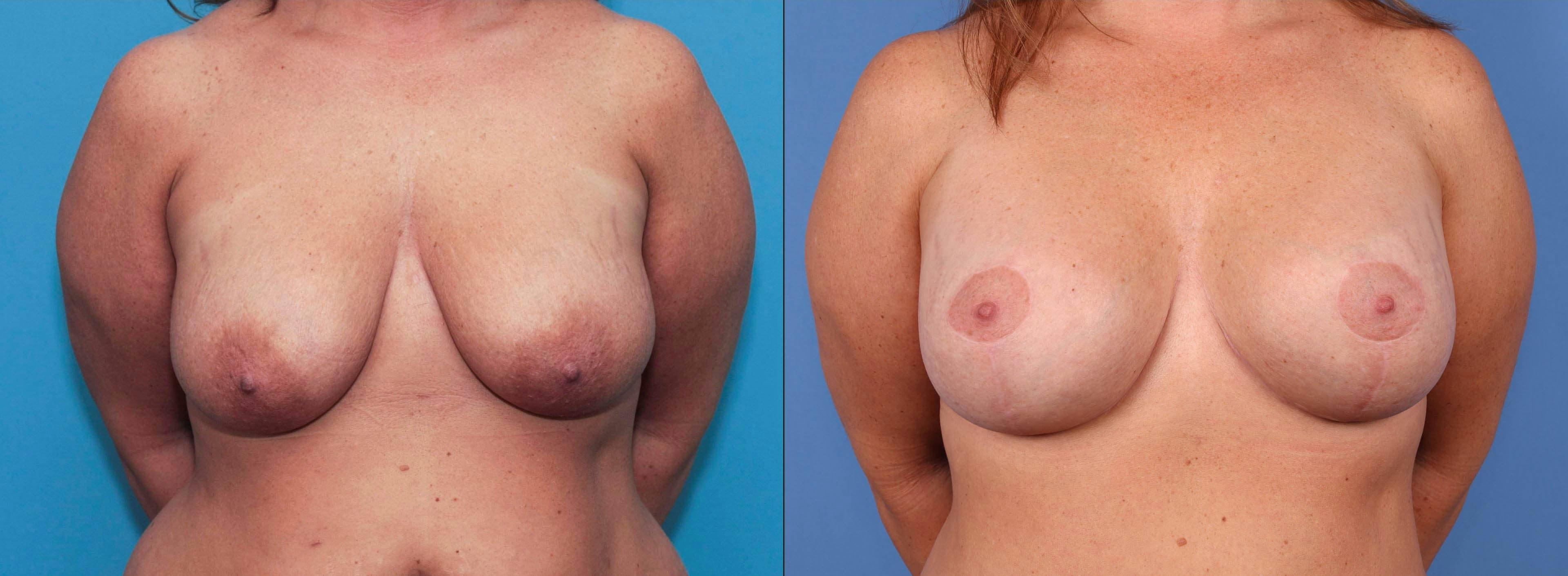 Breast Lift Before & After Gallery - Patient 90354636 - Image 1