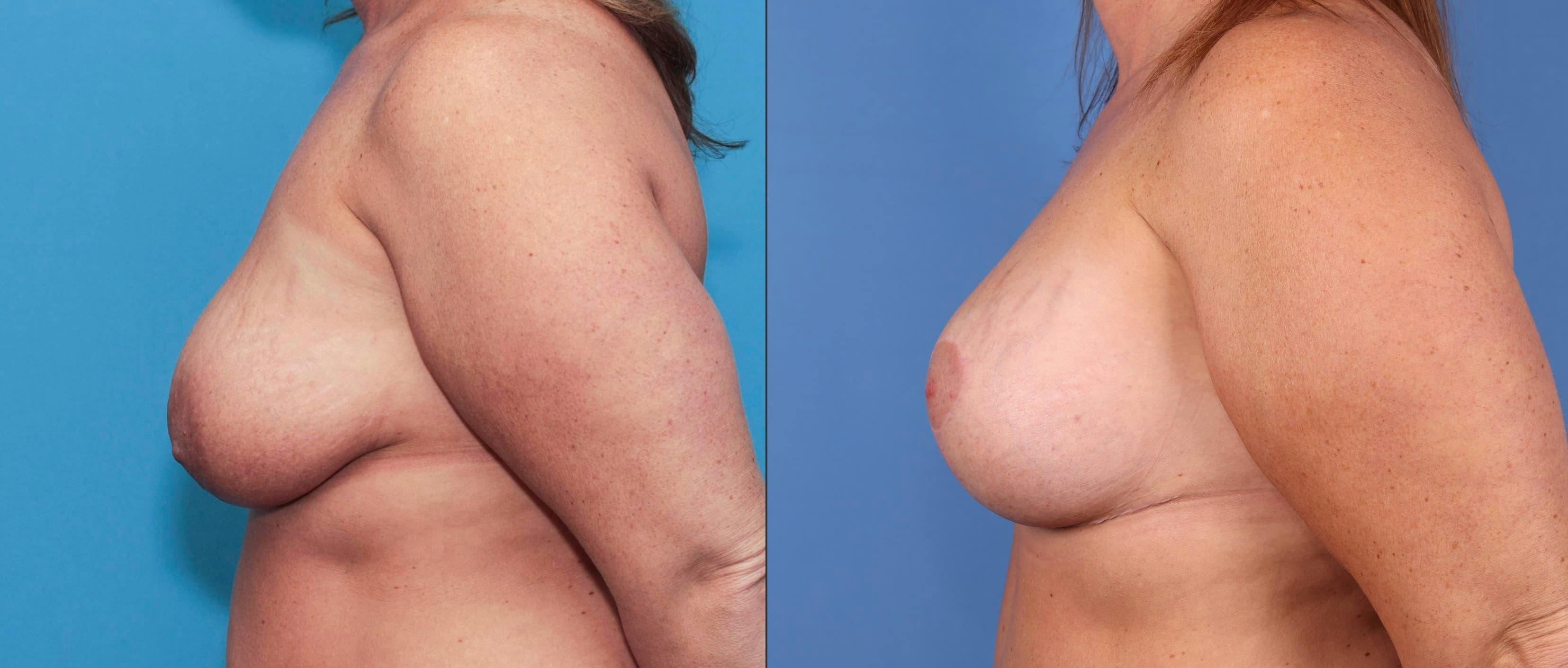 Breast Lift Before & After Gallery - Patient 90354636 - Image 5