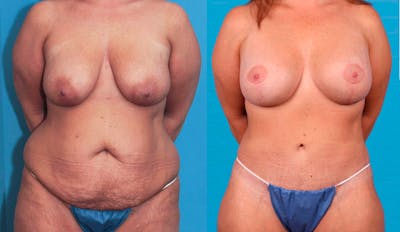 Mommy Makeover Before & After Gallery - Patient 90354572 - Image 1