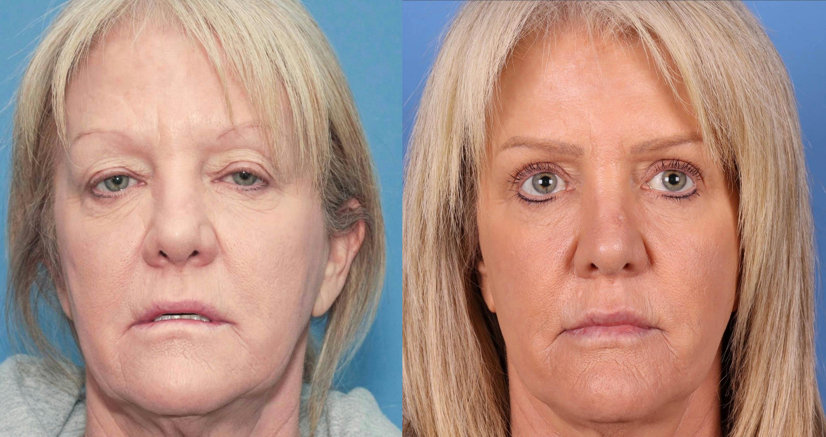 Eyelid Surgery (Upper Blepharoplasty) Before & After Gallery - Patient 90354734 - Image 1