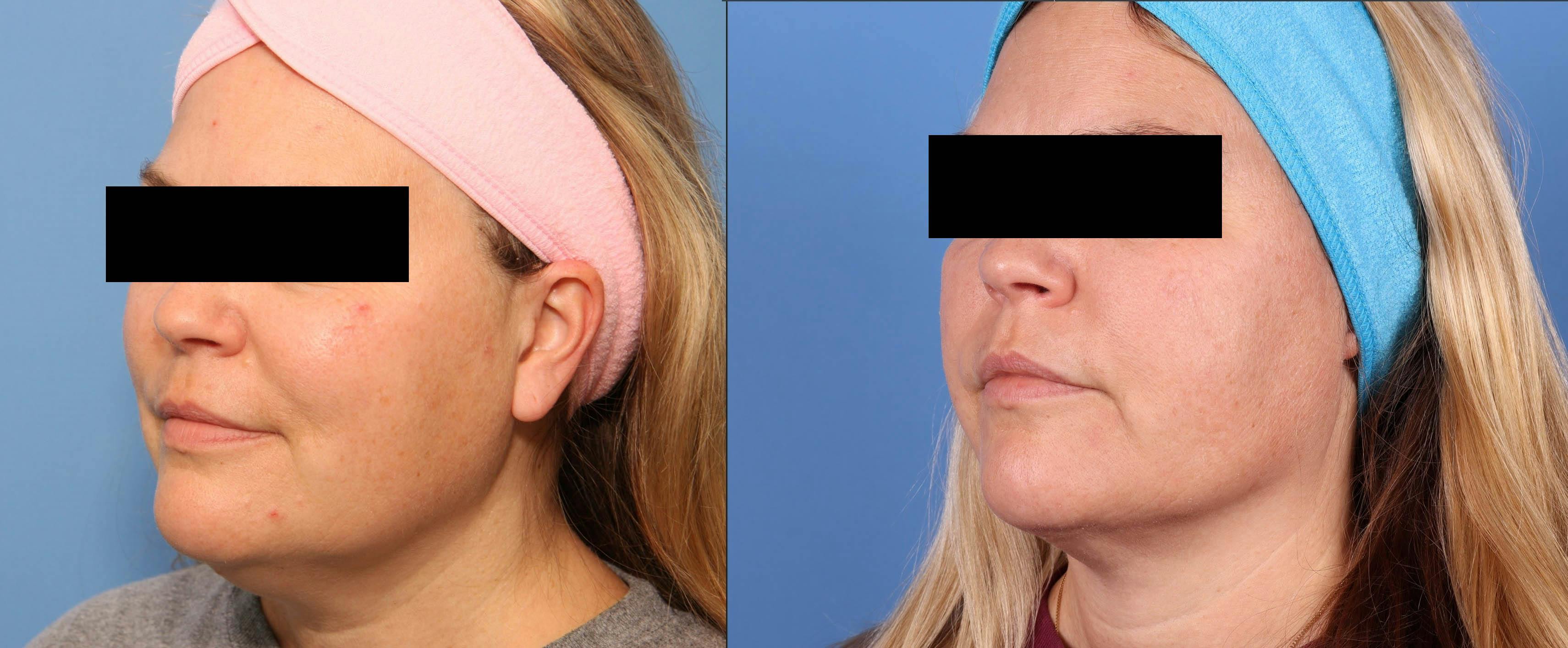 Face Before & After Gallery - Patient 149385108 - Image 2