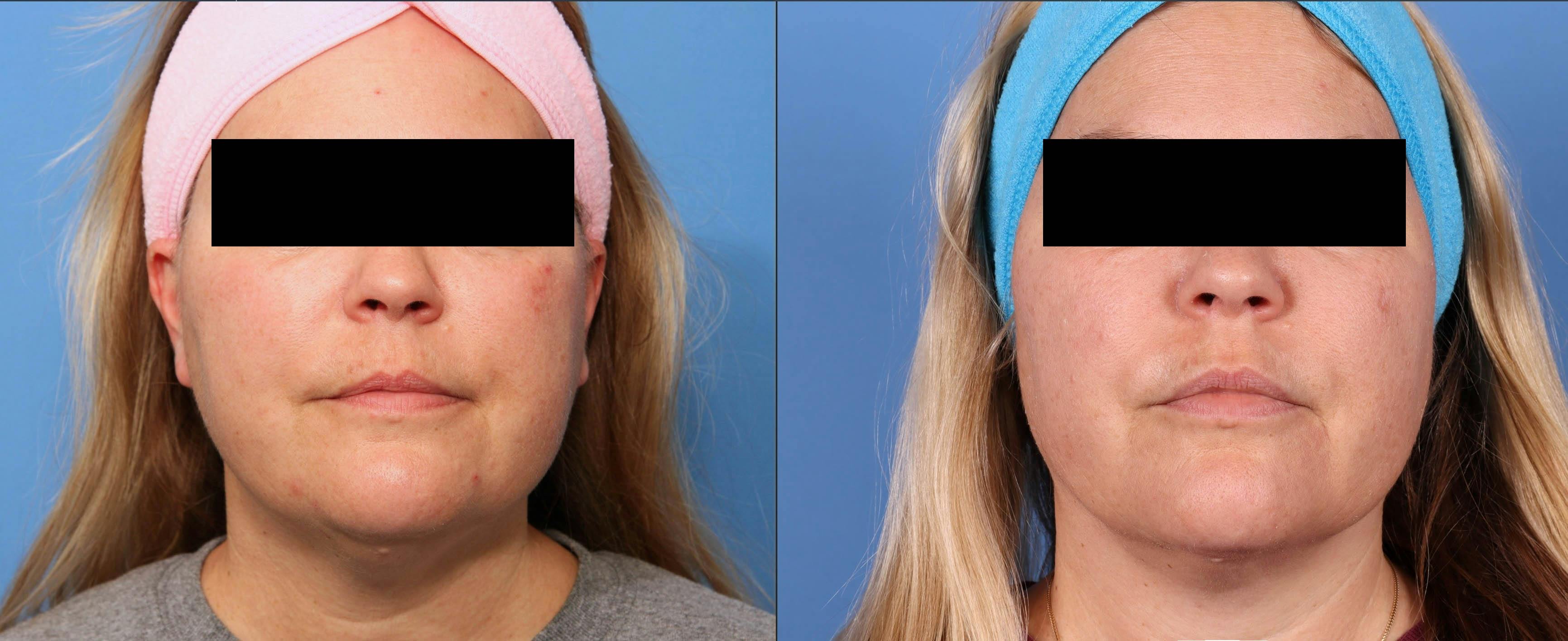 Liposuction Before & After Gallery - Patient 93222810 - Image 2