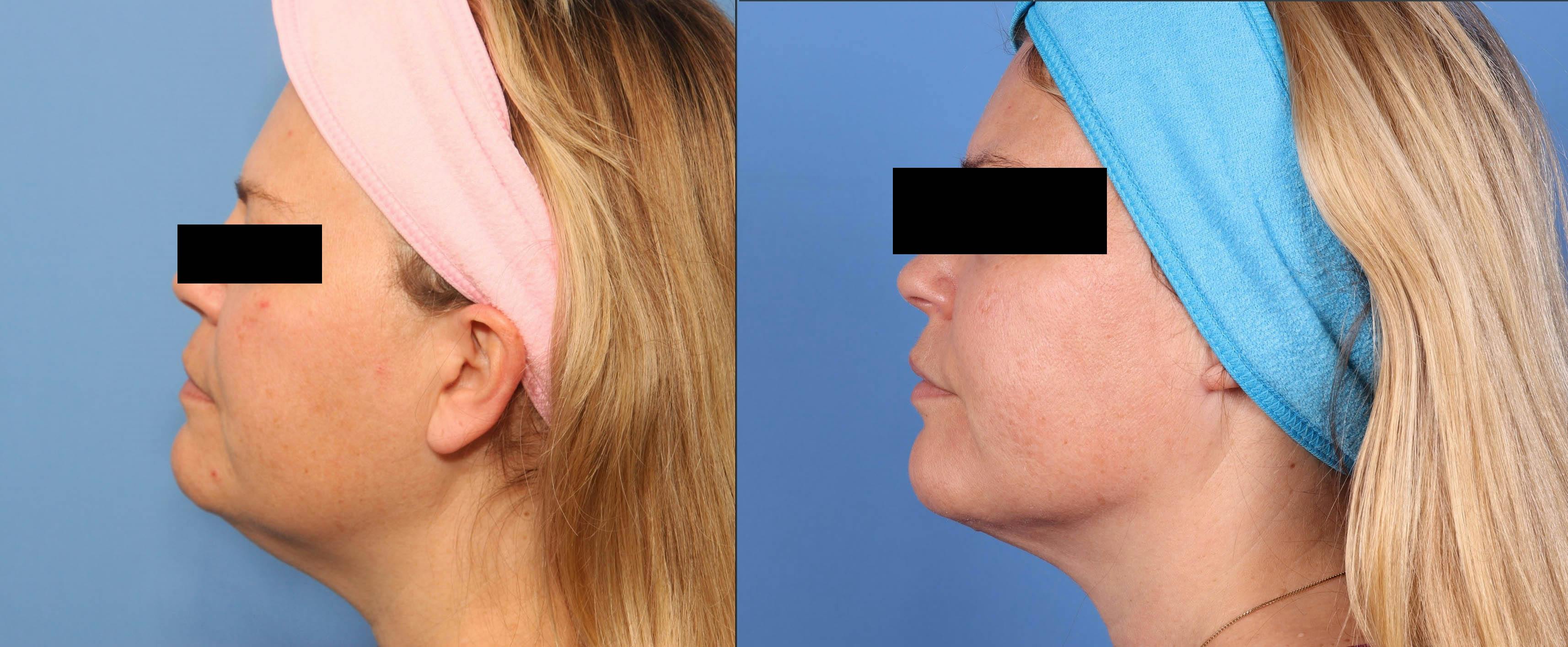 Face Before & After Gallery - Patient 149385108 - Image 3