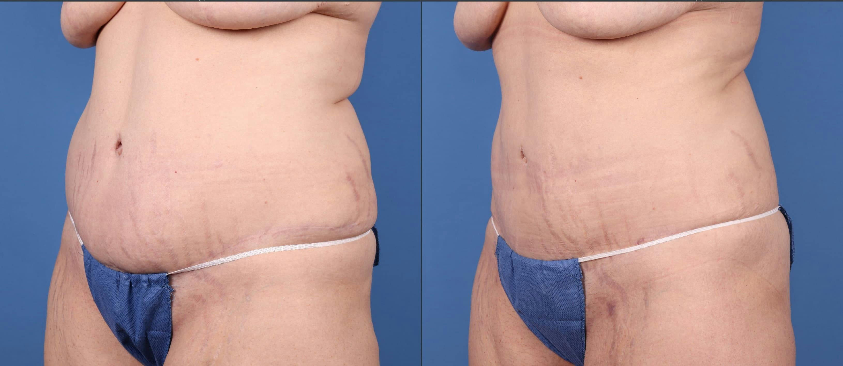 Abdomen Before & After Gallery - Patient 149385213 - Image 2