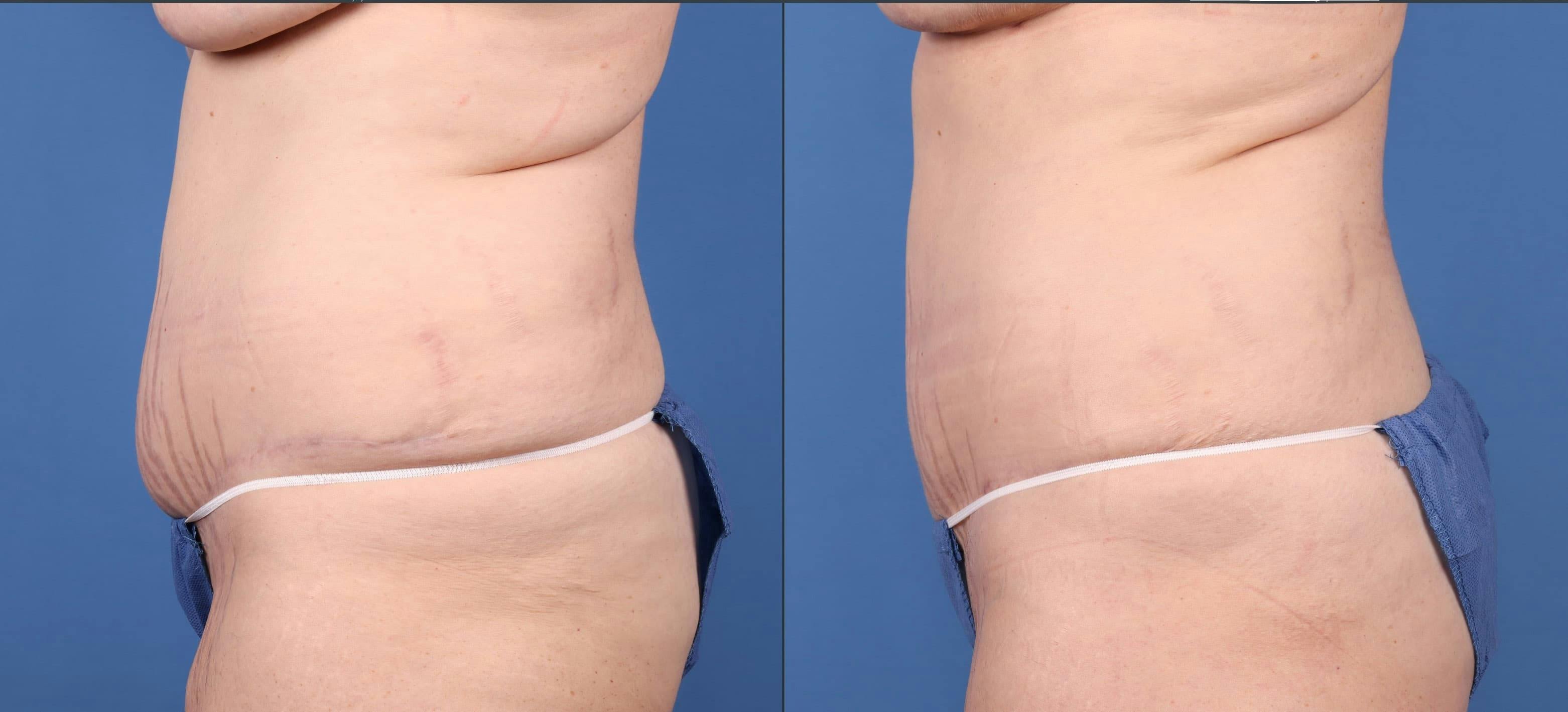 Abdomen Before & After Gallery - Patient 149385213 - Image 3