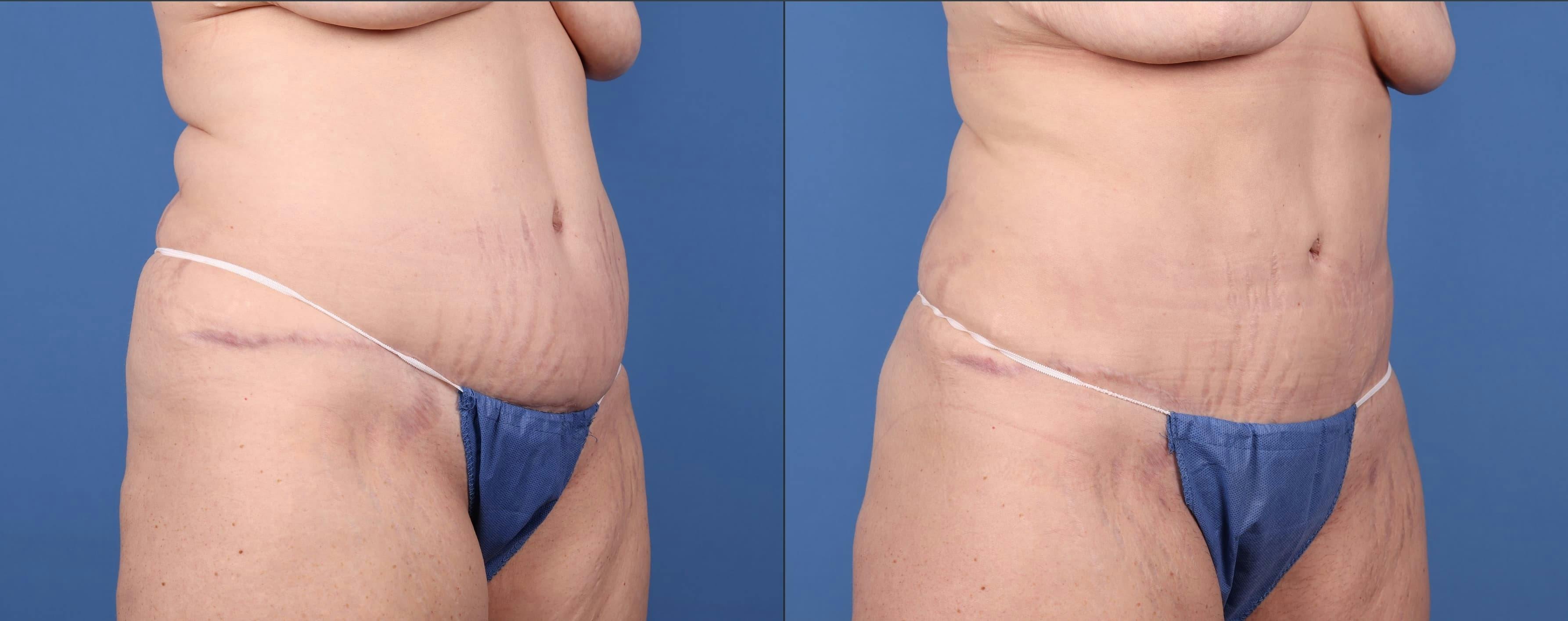 Abdomen Before & After Gallery - Patient 149385213 - Image 4