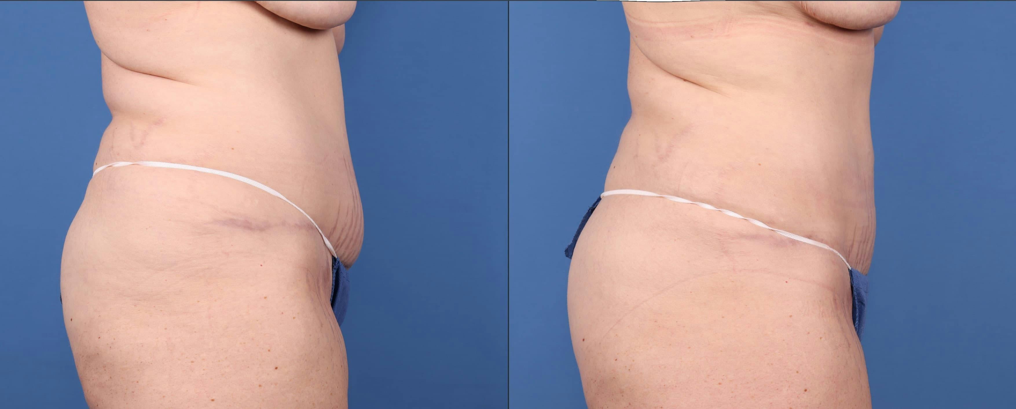 Abdomen Before & After Gallery - Patient 149385213 - Image 5