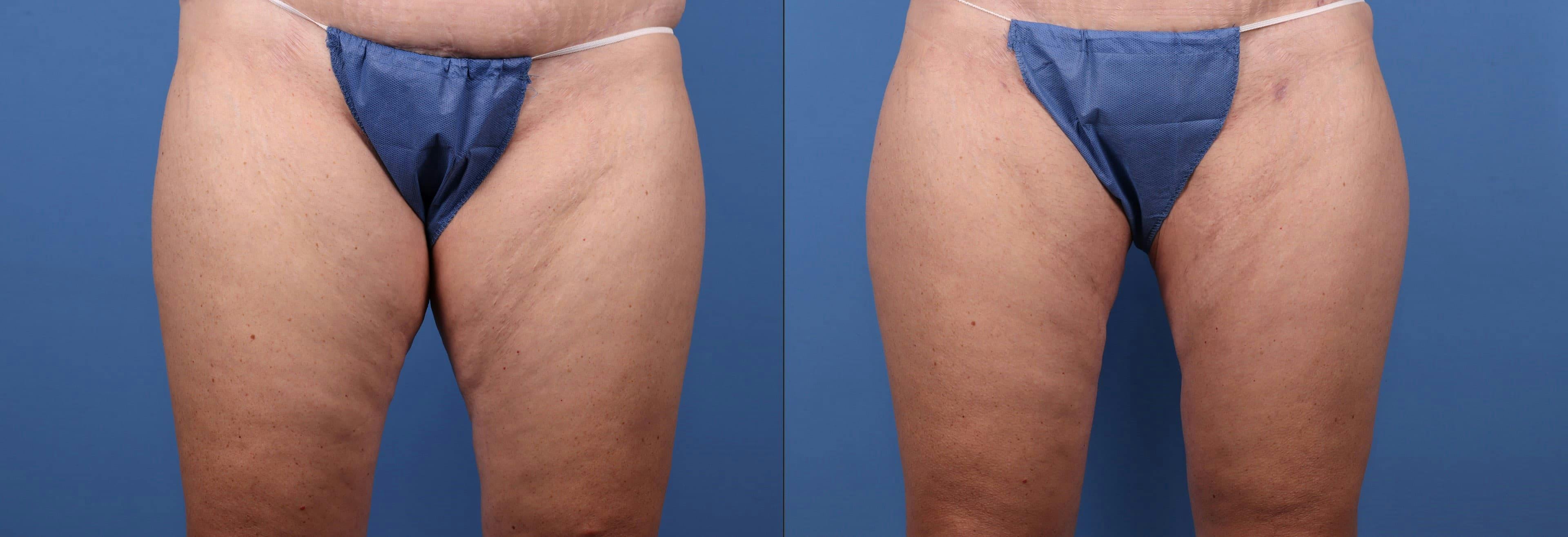 Thighs Before & After Gallery - Patient 149385423 - Image 1
