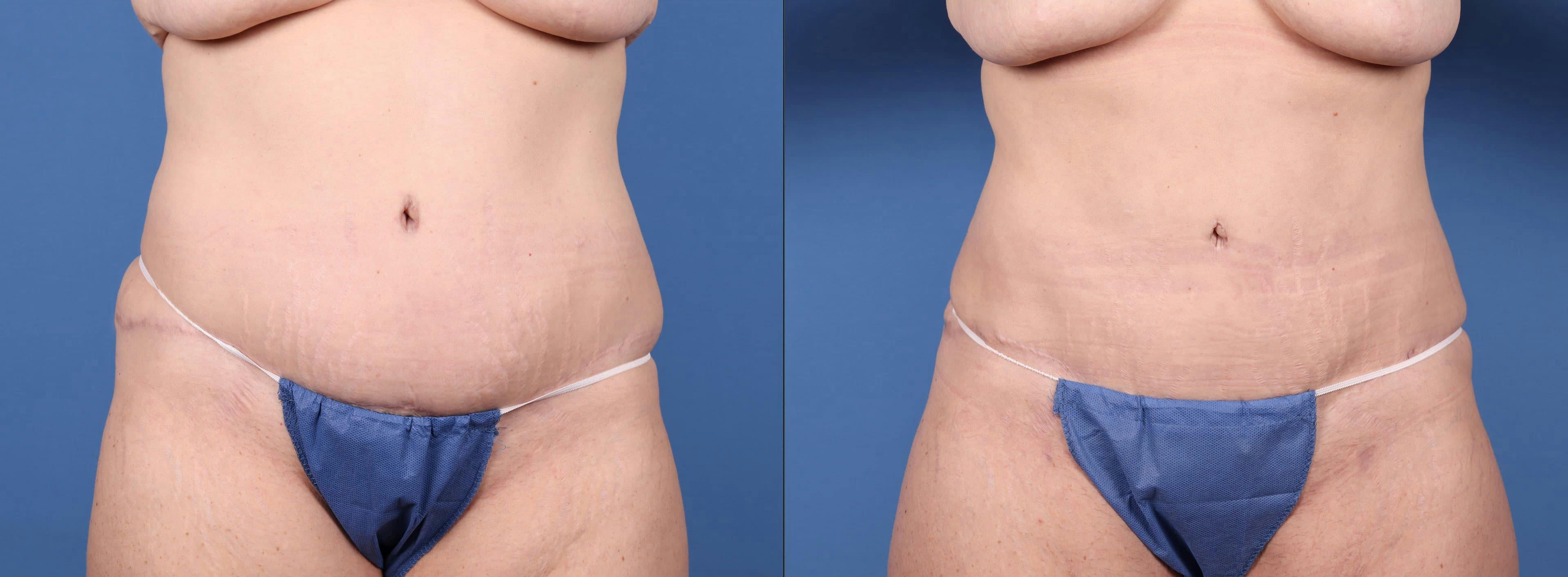 Abdomen Before & After Gallery - Patient 149385213 - Image 1