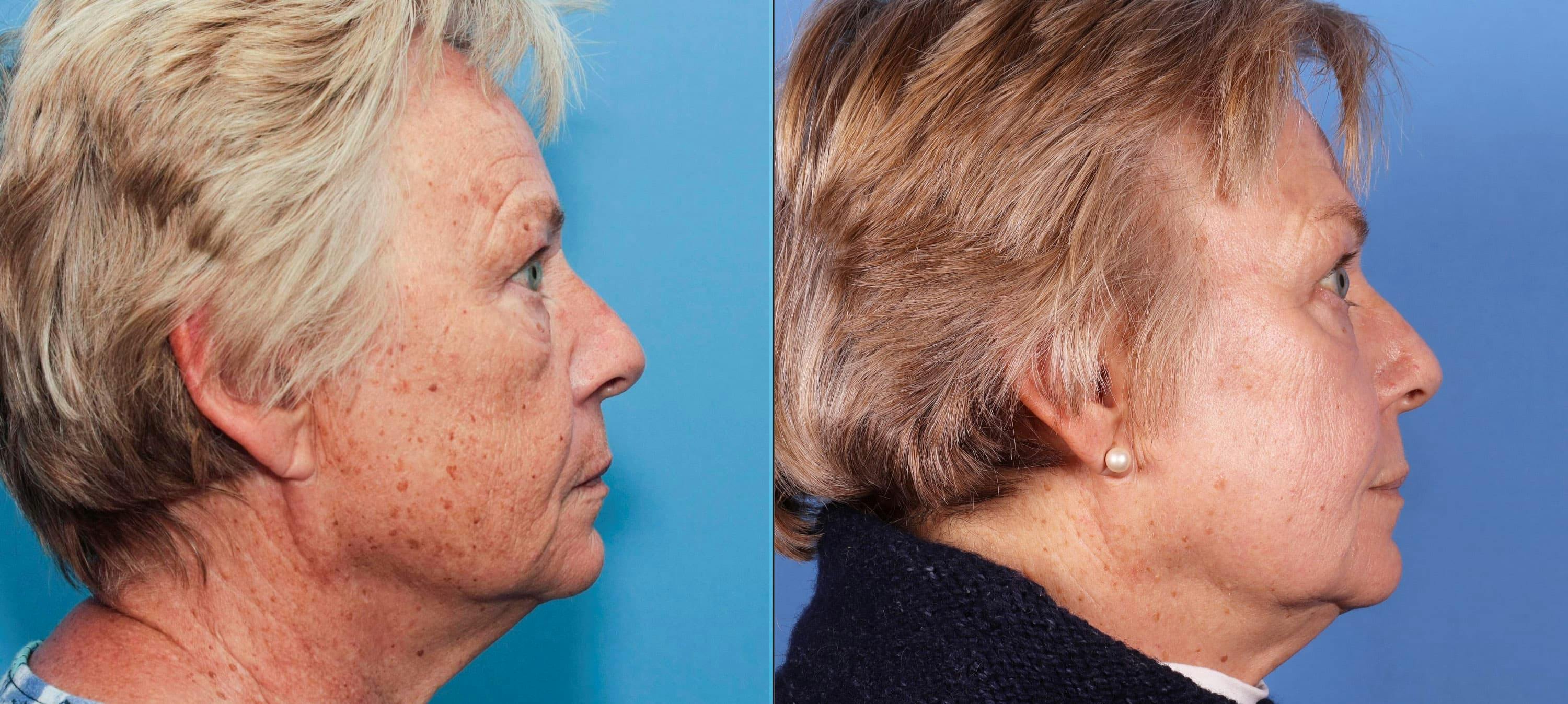 Contour TRL Laser Before & After Gallery - Patient 94033894 - Image 2