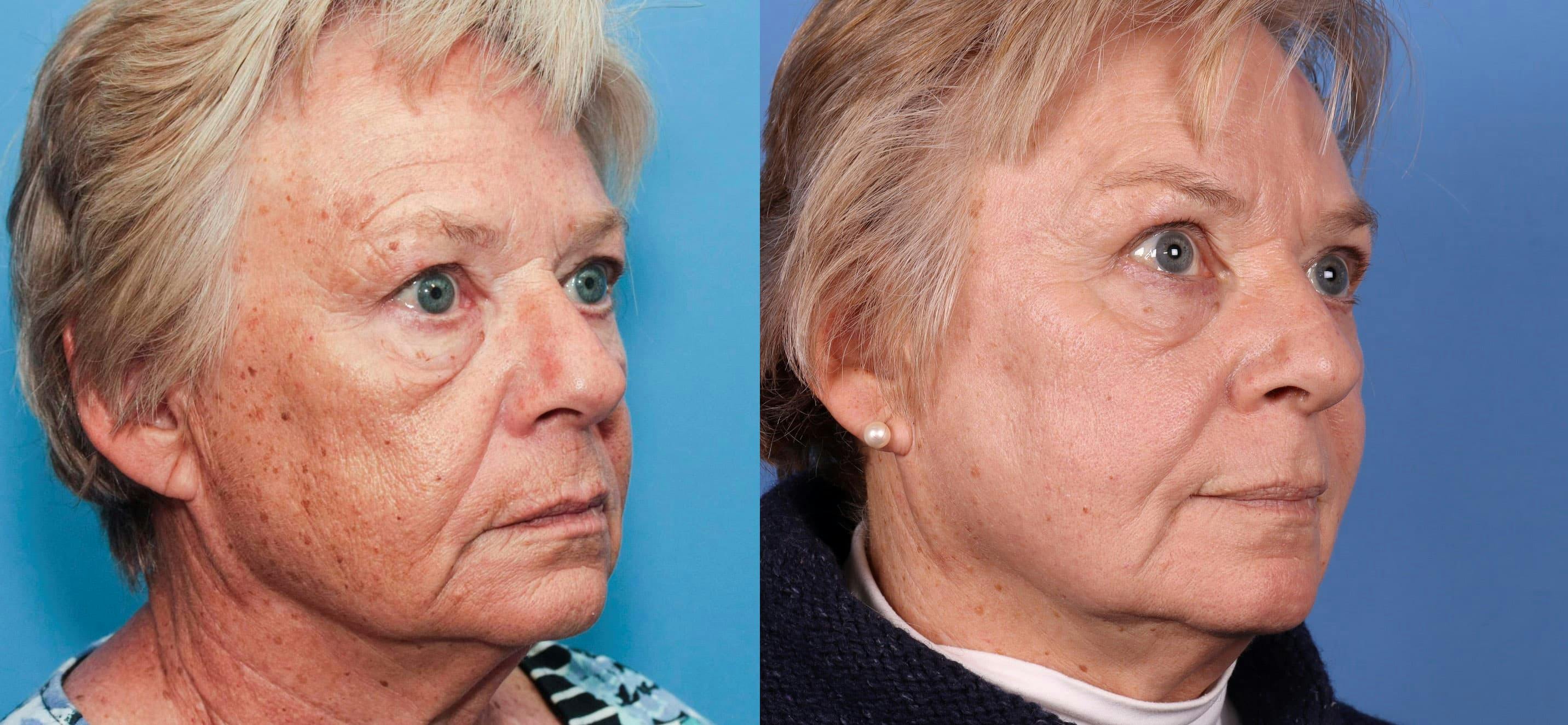 Contour TRL Laser Before & After Gallery - Patient 94033894 - Image 3