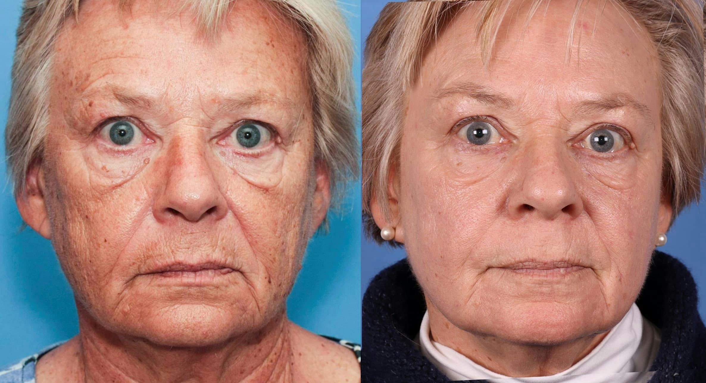 Contour TRL Laser Before & After Gallery - Patient 94033894 - Image 1