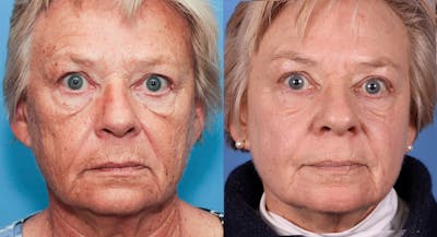 Contour TRL Laser Before & After Gallery - Patient 94033894 - Image 1
