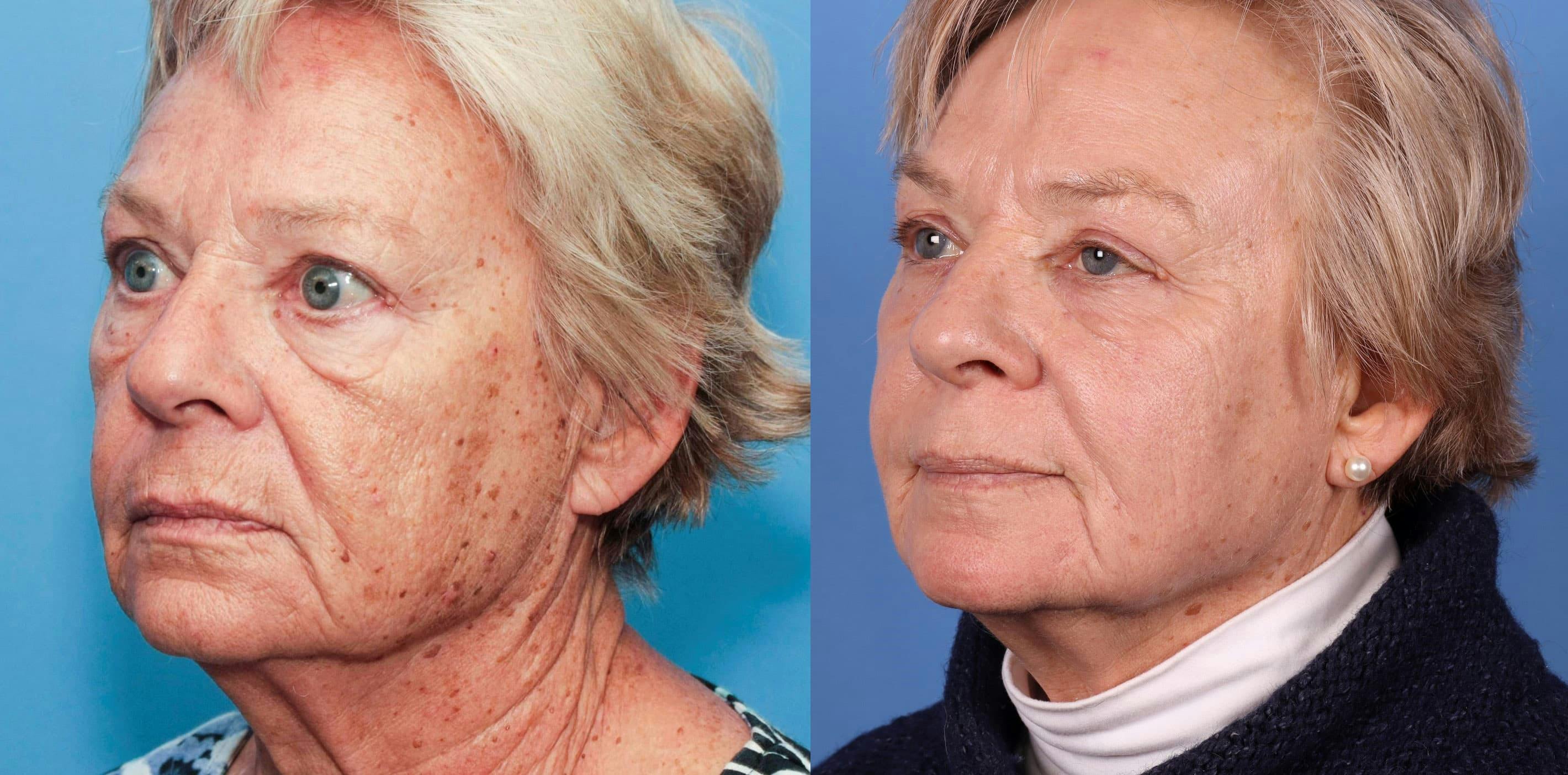 Contour TRL Laser Before & After Gallery - Patient 94033894 - Image 4