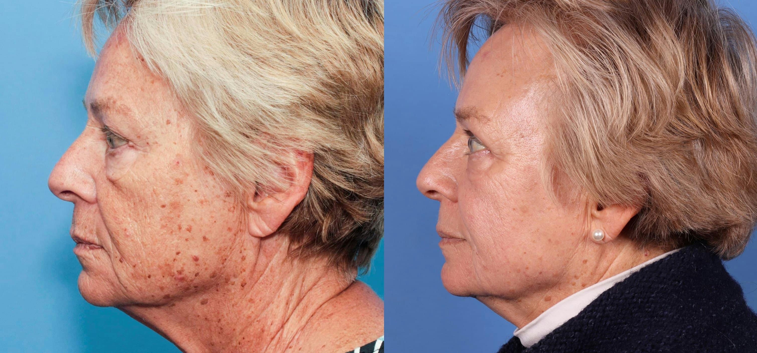 Contour TRL Laser Before & After Gallery - Patient 94033894 - Image 5