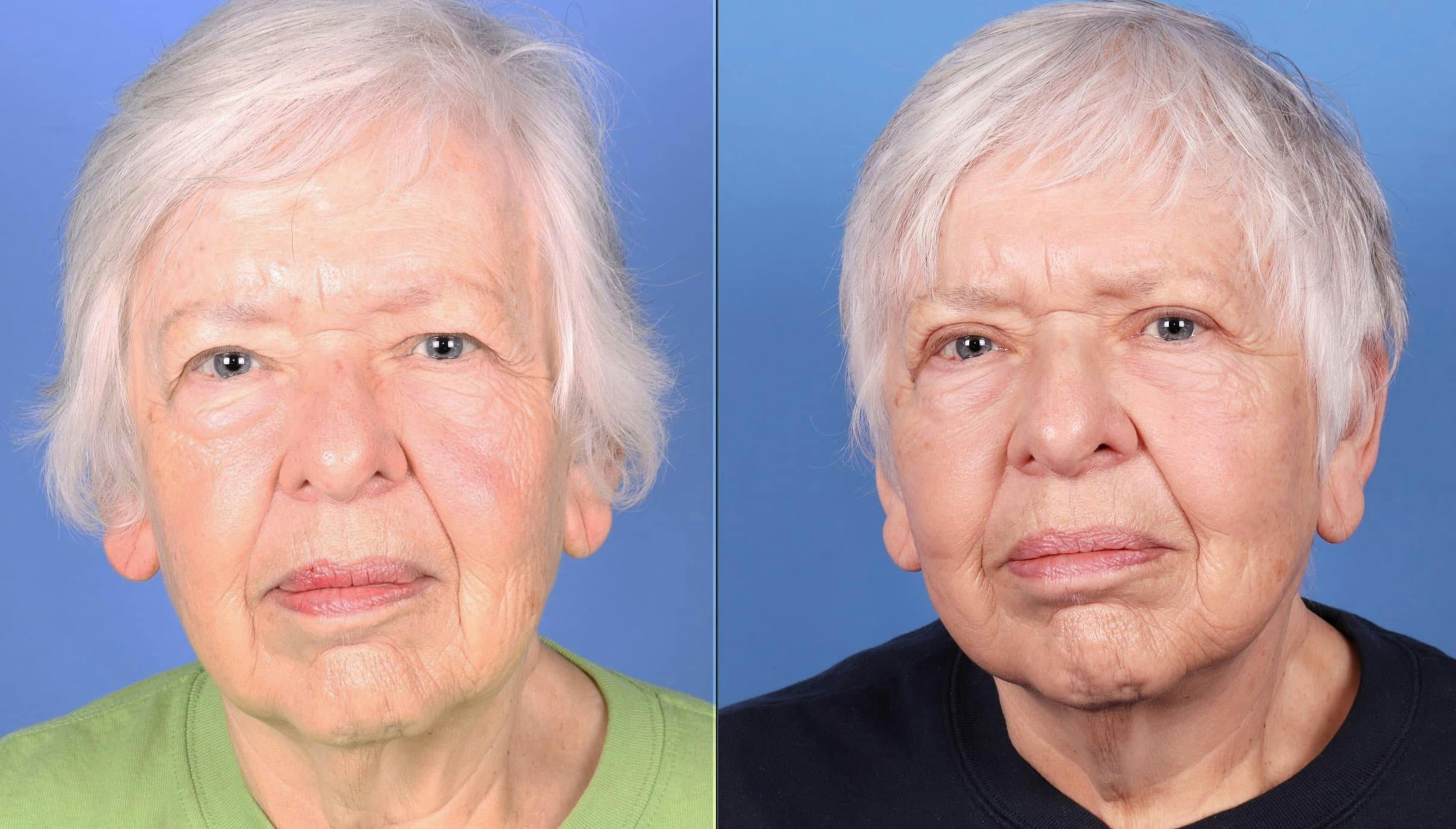 Face Lift Before & After Gallery - Patient 95341582 - Image 1