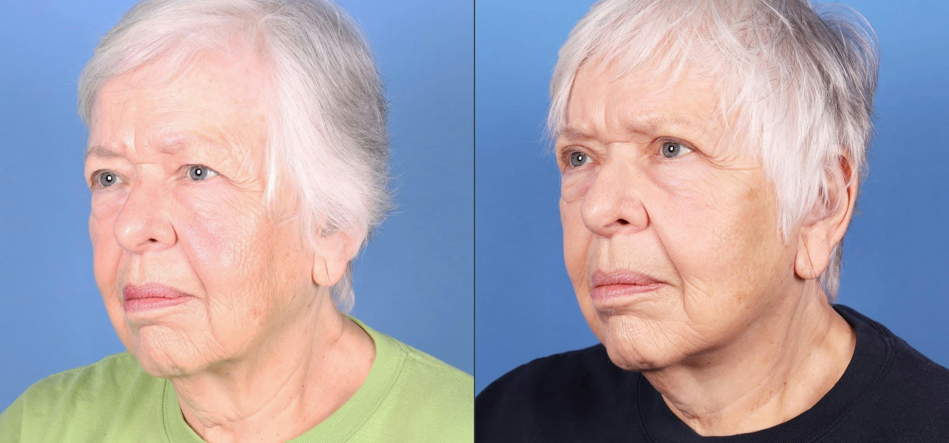 Face Lift Before & After Gallery - Patient 95341582 - Image 2