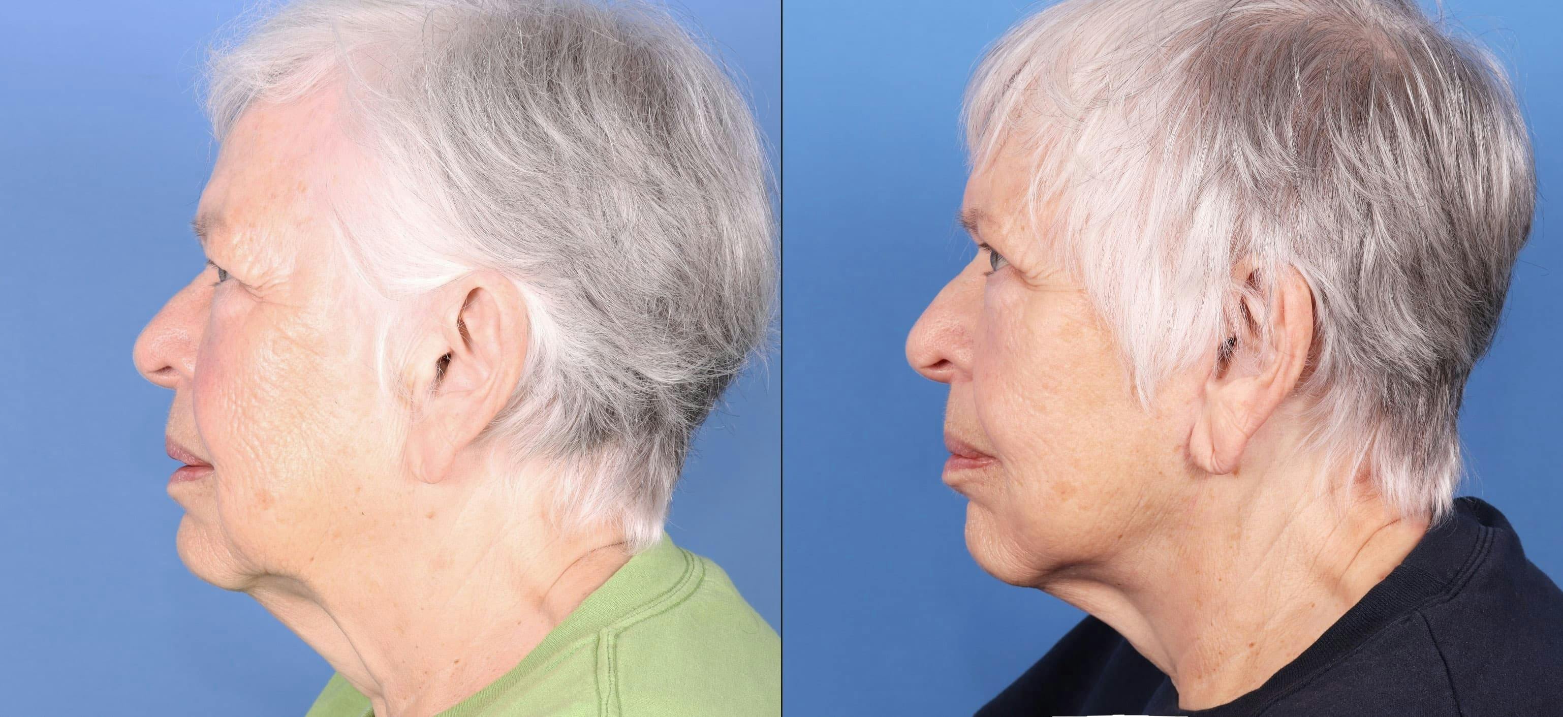 Face Lift Before & After Gallery - Patient 95341582 - Image 3