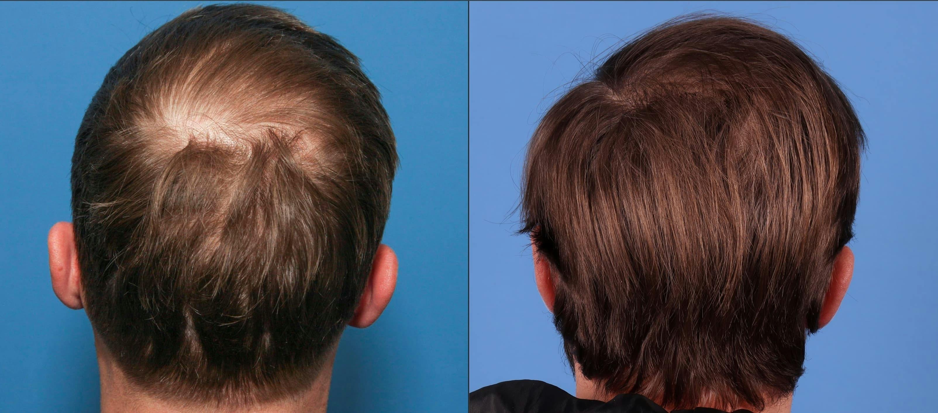 NeoGraft Hair Restoration Before & After Gallery - Patient 95341714 - Image 2