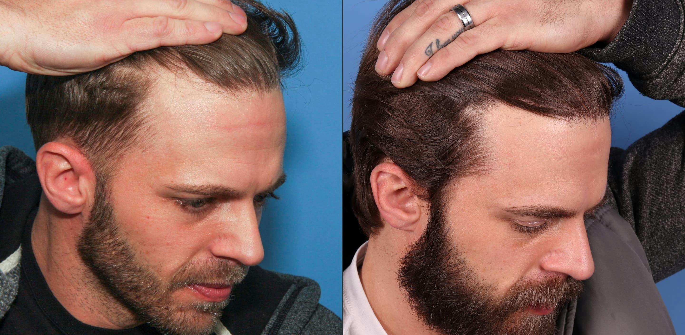 NeoGraft Hair Restoration Before & After Gallery - Patient 95341714 - Image 3