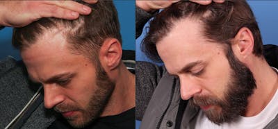 NeoGraft Hair Restoration Before & After Gallery - Patient 95341714 - Image 1