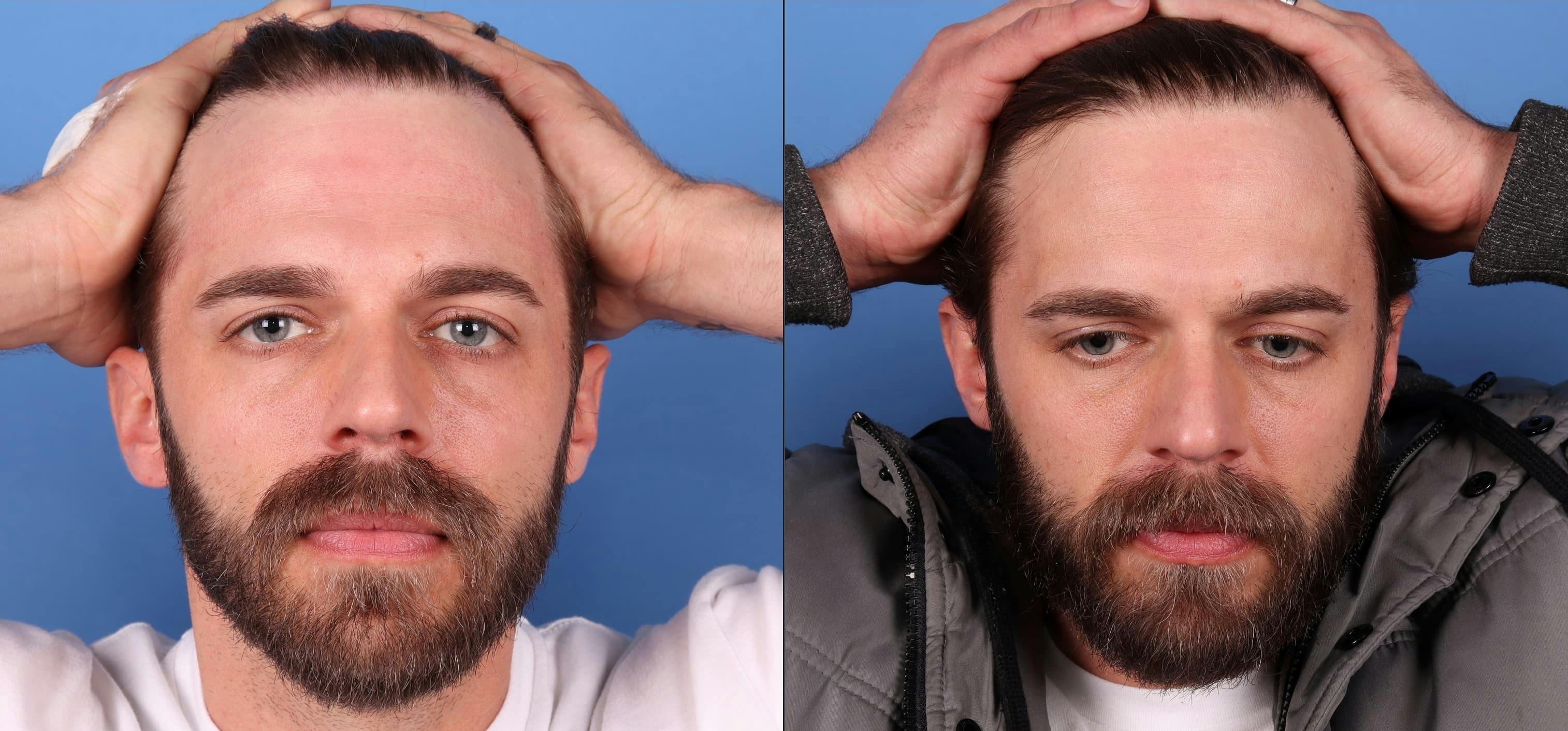 NeoGraft Hair Restoration Before & After Gallery - Patient 95341714 - Image 4