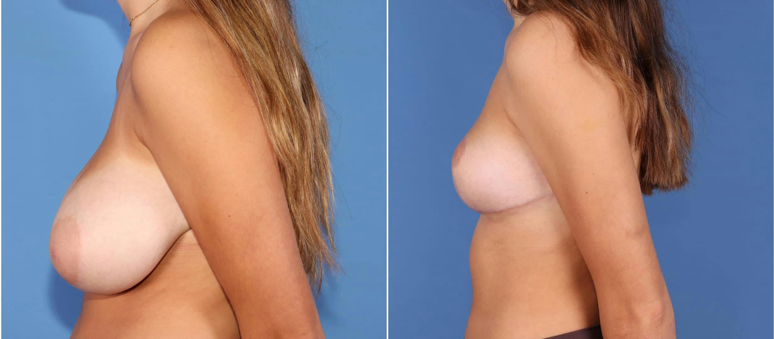 Breast Reduction Before & After Gallery - Patient 97538034 - Image 2