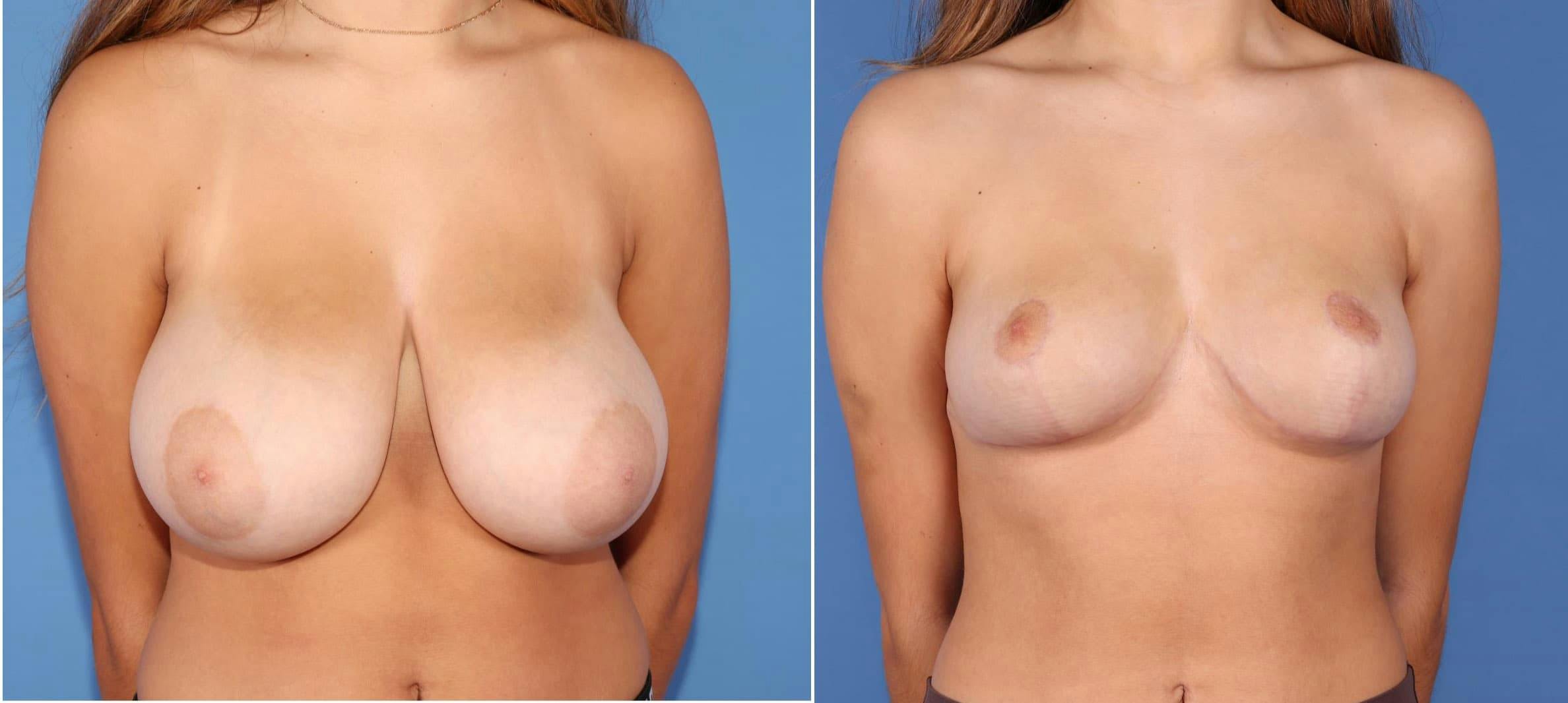 Breast Reduction Before & After Gallery - Patient 97538034 - Image 1