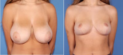 Breast Reduction Before & After Gallery - Patient 97538034 - Image 1