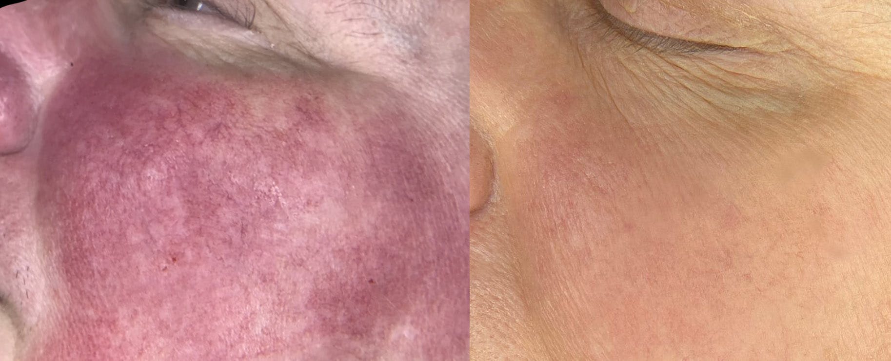 IPL Before & After Gallery - Patient 97539524 - Image 1