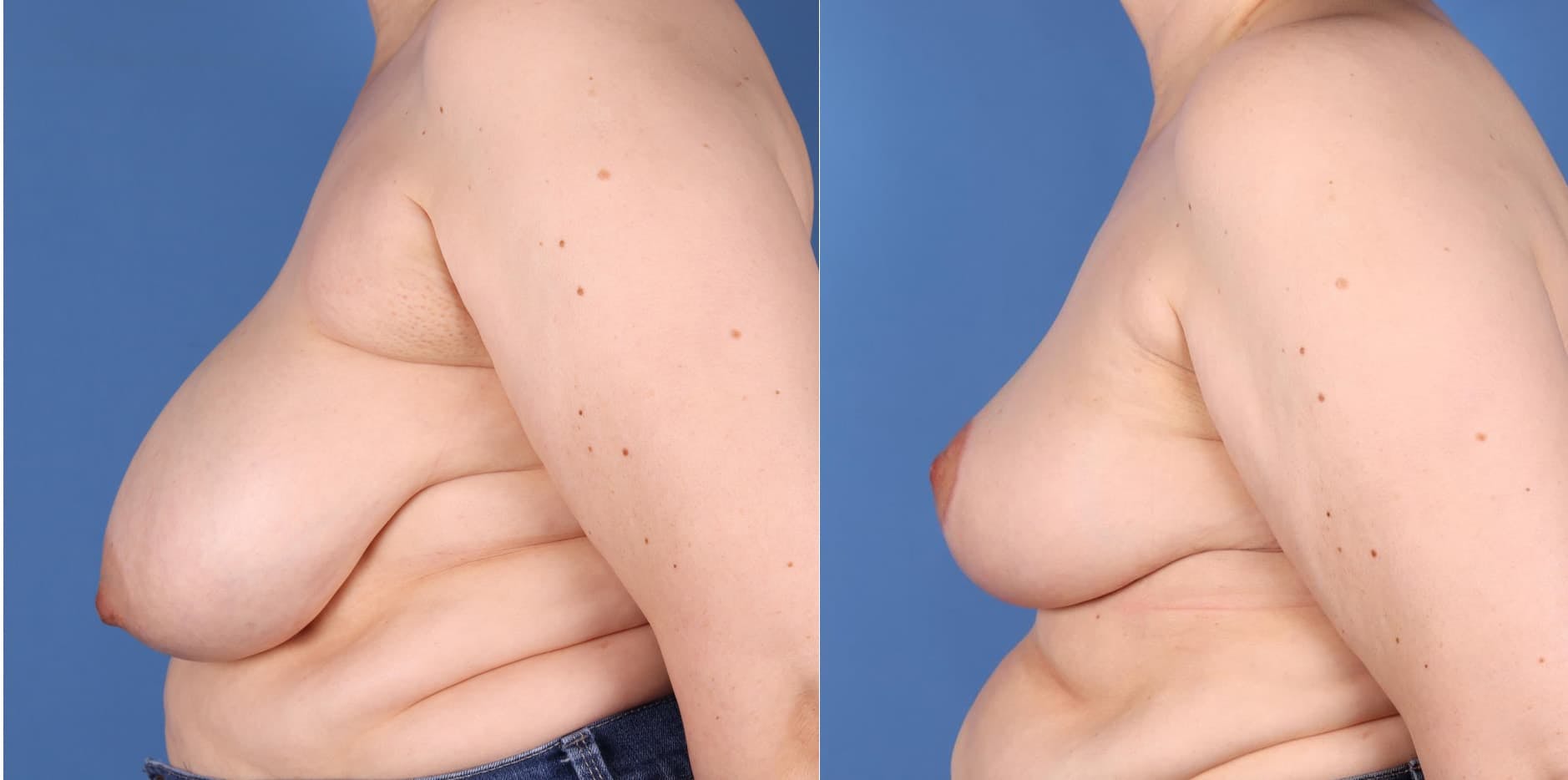 Breast Reduction Before & After Gallery - Patient 97571314 - Image 3