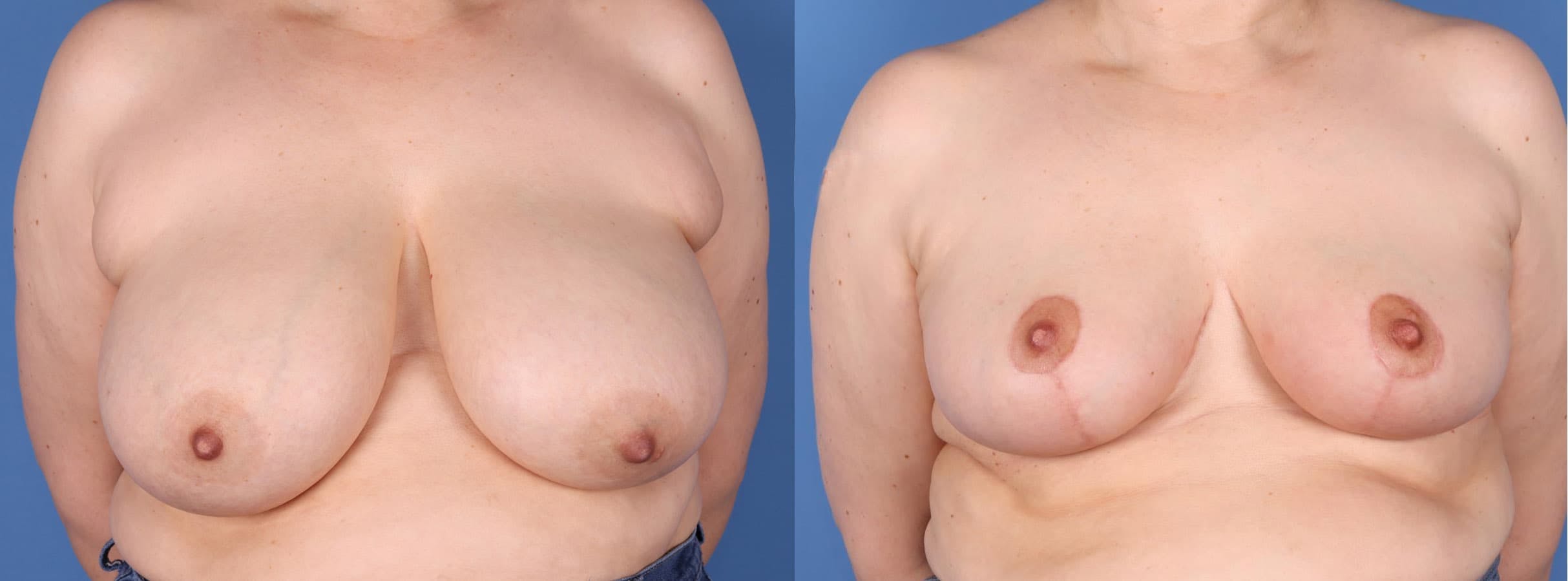 Breast Reduction Before & After Gallery - Patient 97571314 - Image 1