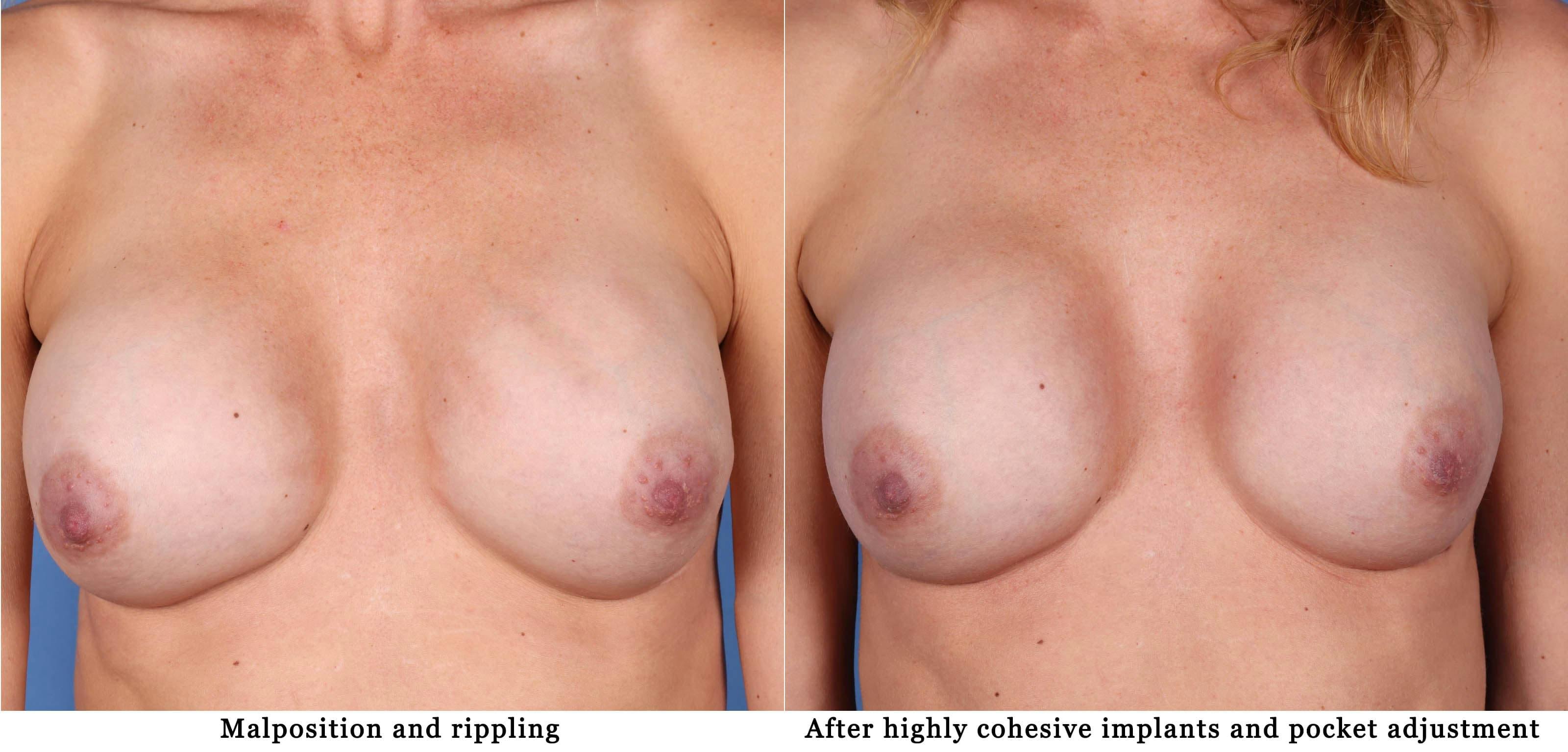 Breast Implant Revision Before & After Gallery - Patient 97571520 - Image 1