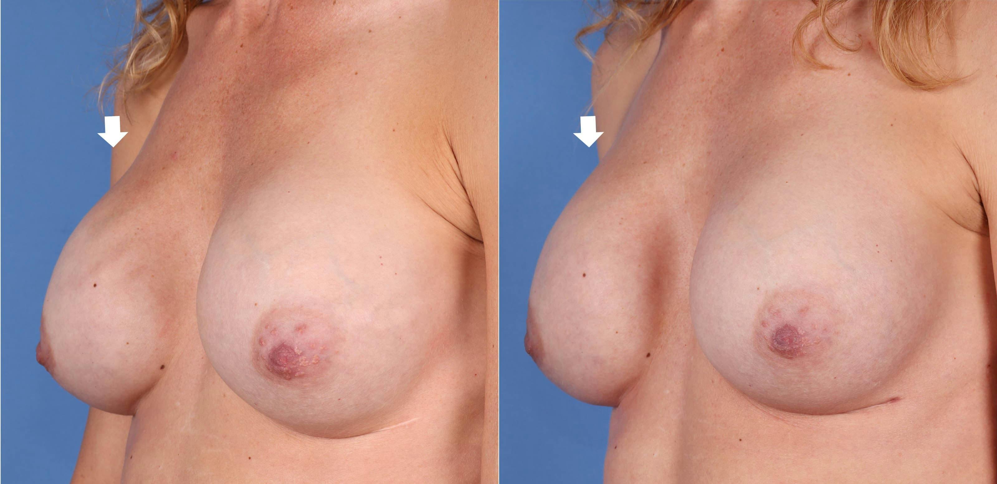 Breast Revision Before & After Gallery - Patient 97571520 - Image 3