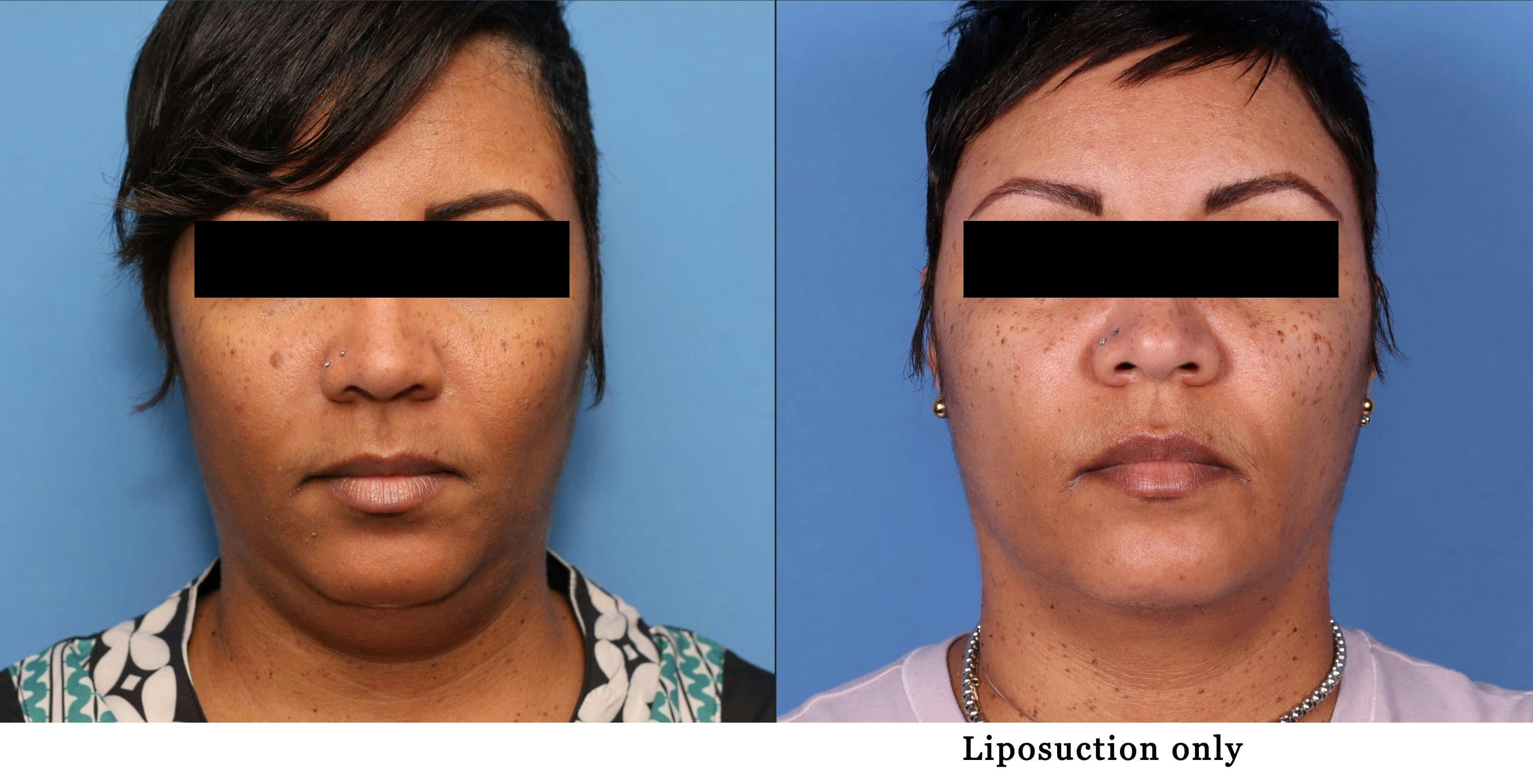 Liposuction Before & After Gallery - Patient 99001664 - Image 1