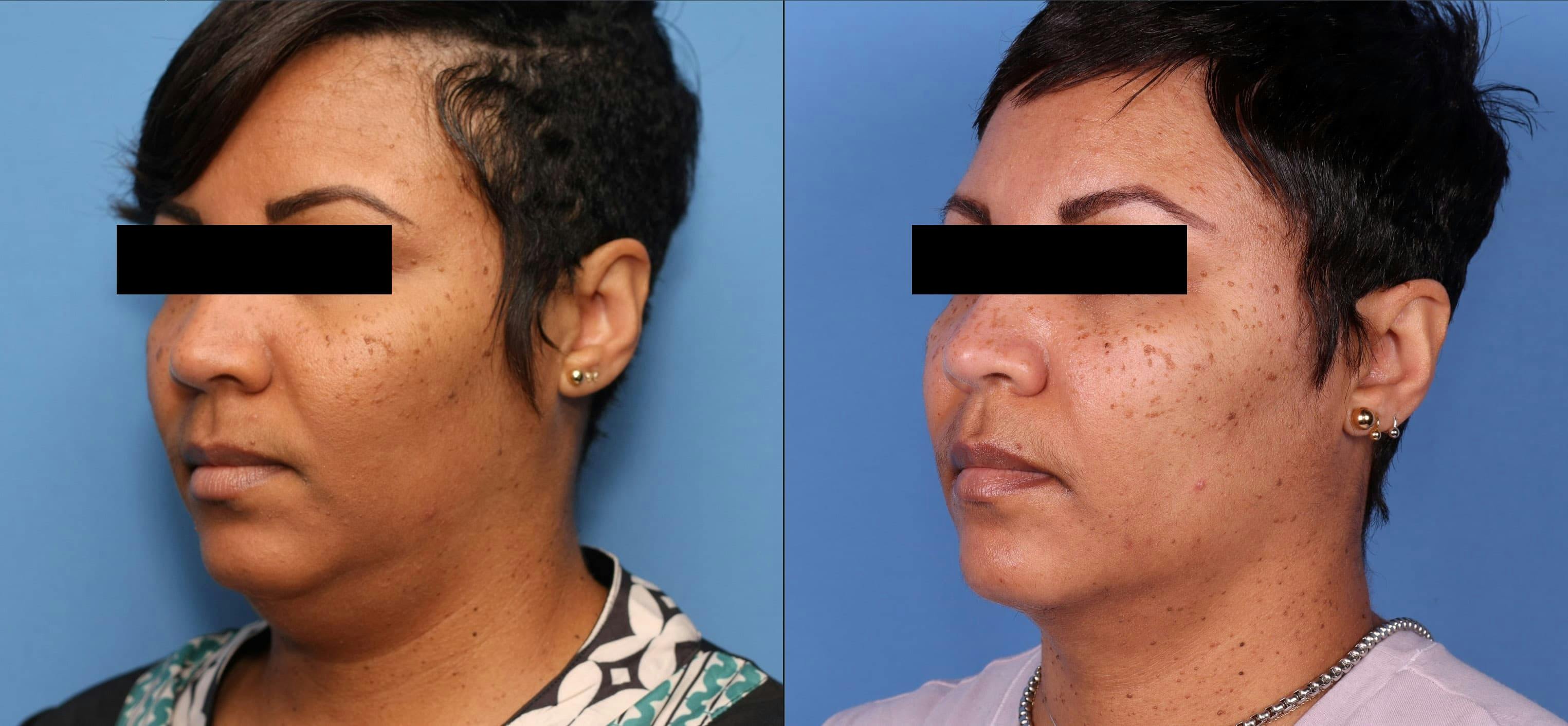 Face & Neck Before & After Gallery - Patient 149385115 - Image 2