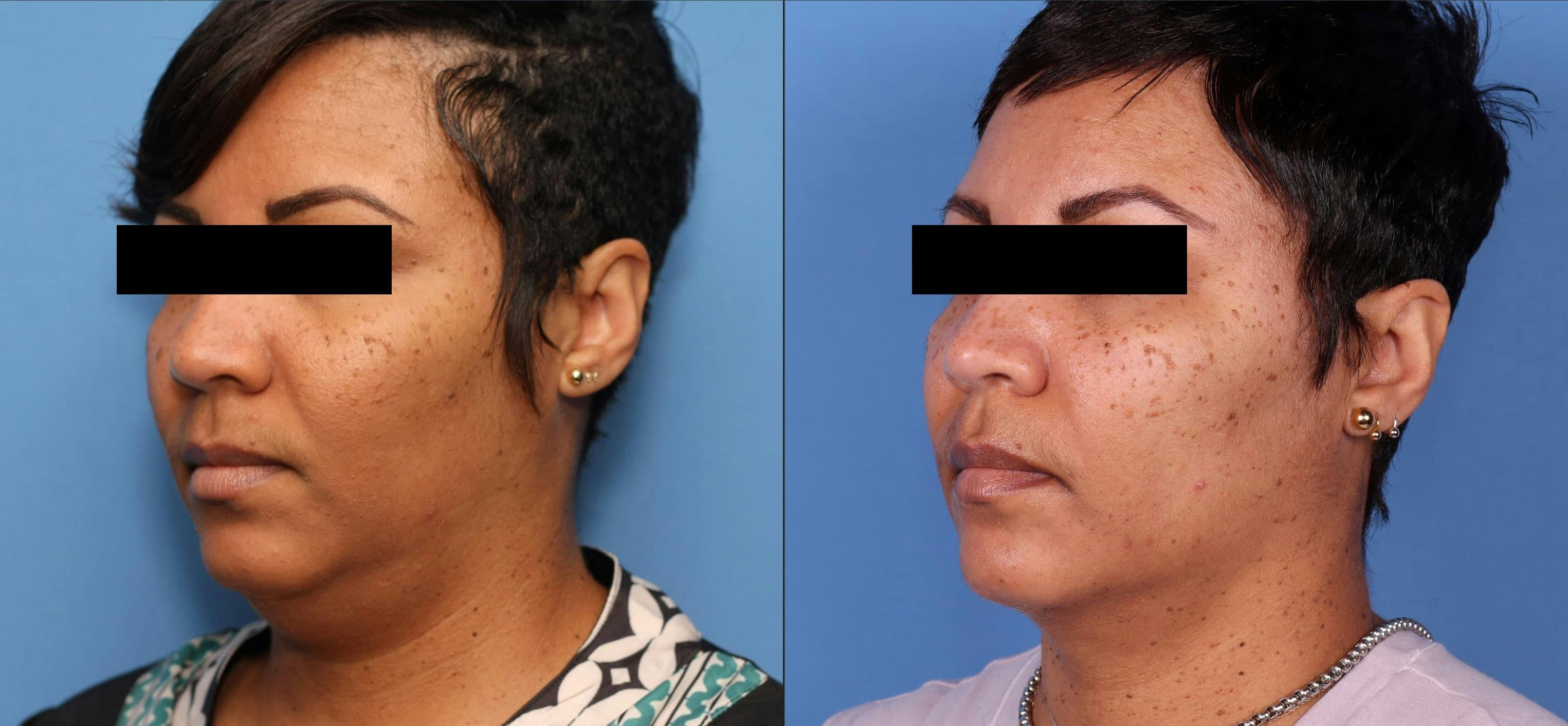 Neck Lift Before & After Gallery - Patient 99001526 - Image 2